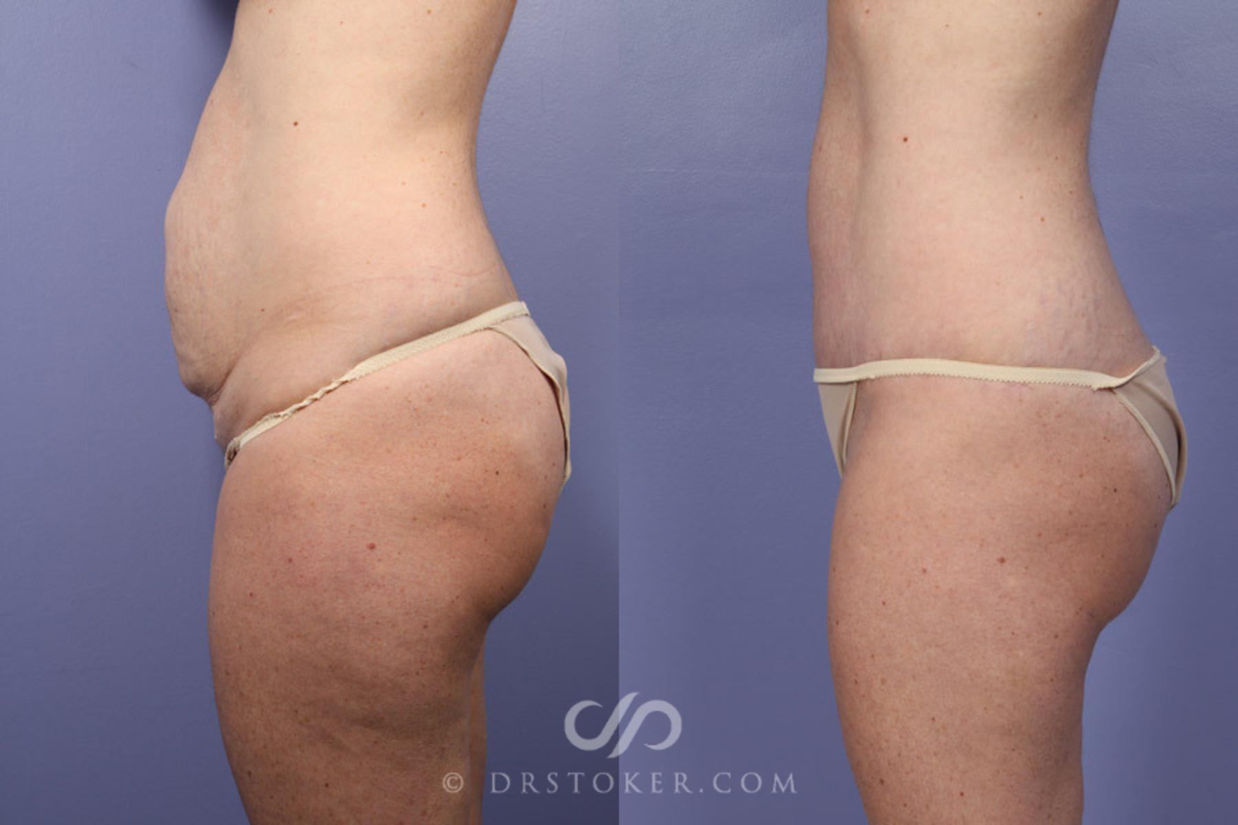 Before & After Breast Lift Case 343 View #14 View in Los Angeles, CA