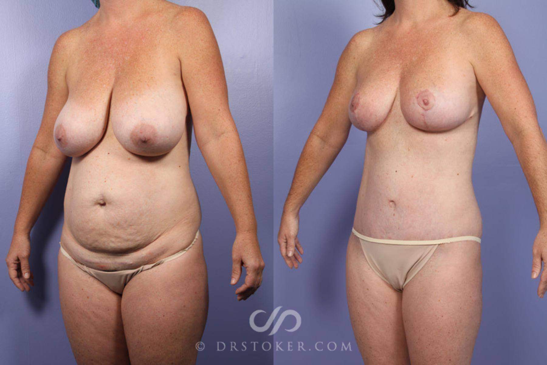 Before & After Tummy Tuck Case 343 View #3 View in Los Angeles, CA