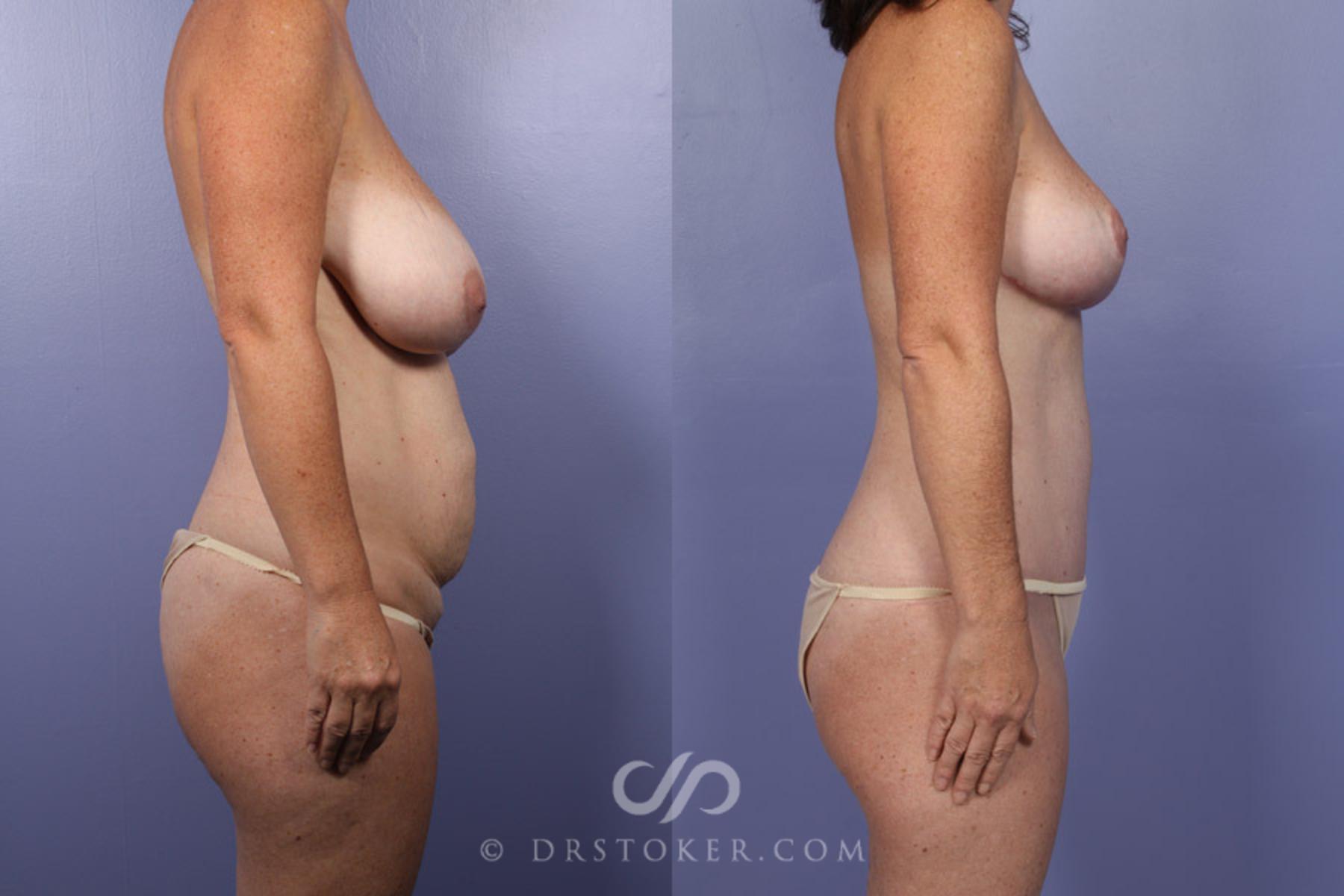 Before & After Liposuction Case 343 View #4 View in Los Angeles, CA