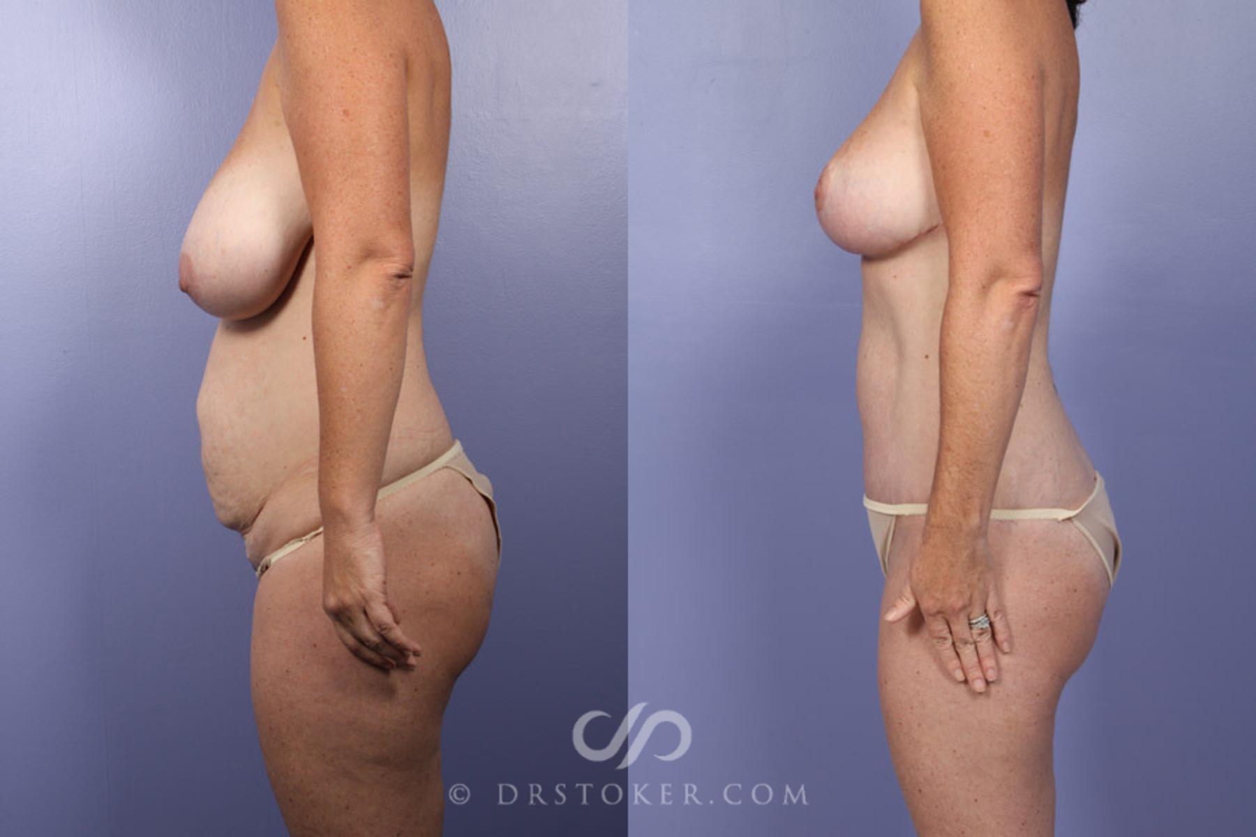 Before & After Liposuction Case 343 View #5 View in Los Angeles, CA