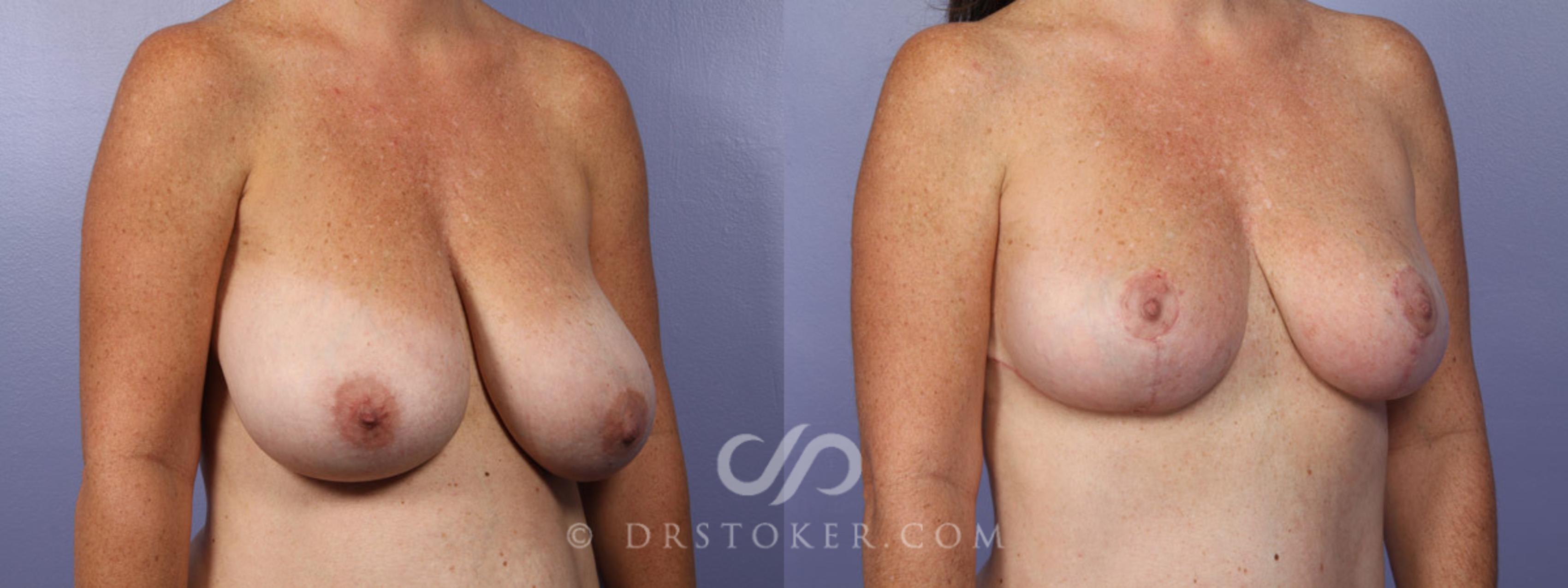 Before & After Liposuction Case 343 View #7 View in Los Angeles, CA