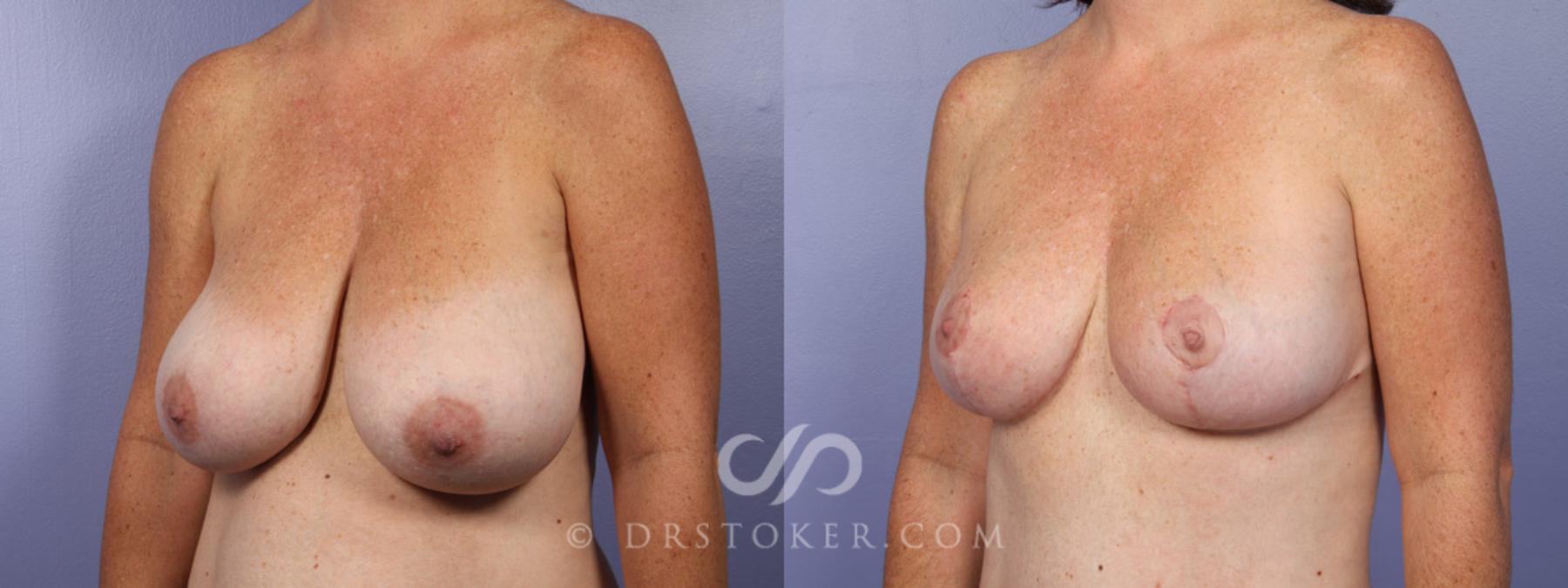 Before & After Breast Lift Case 343 View #8 View in Los Angeles, CA