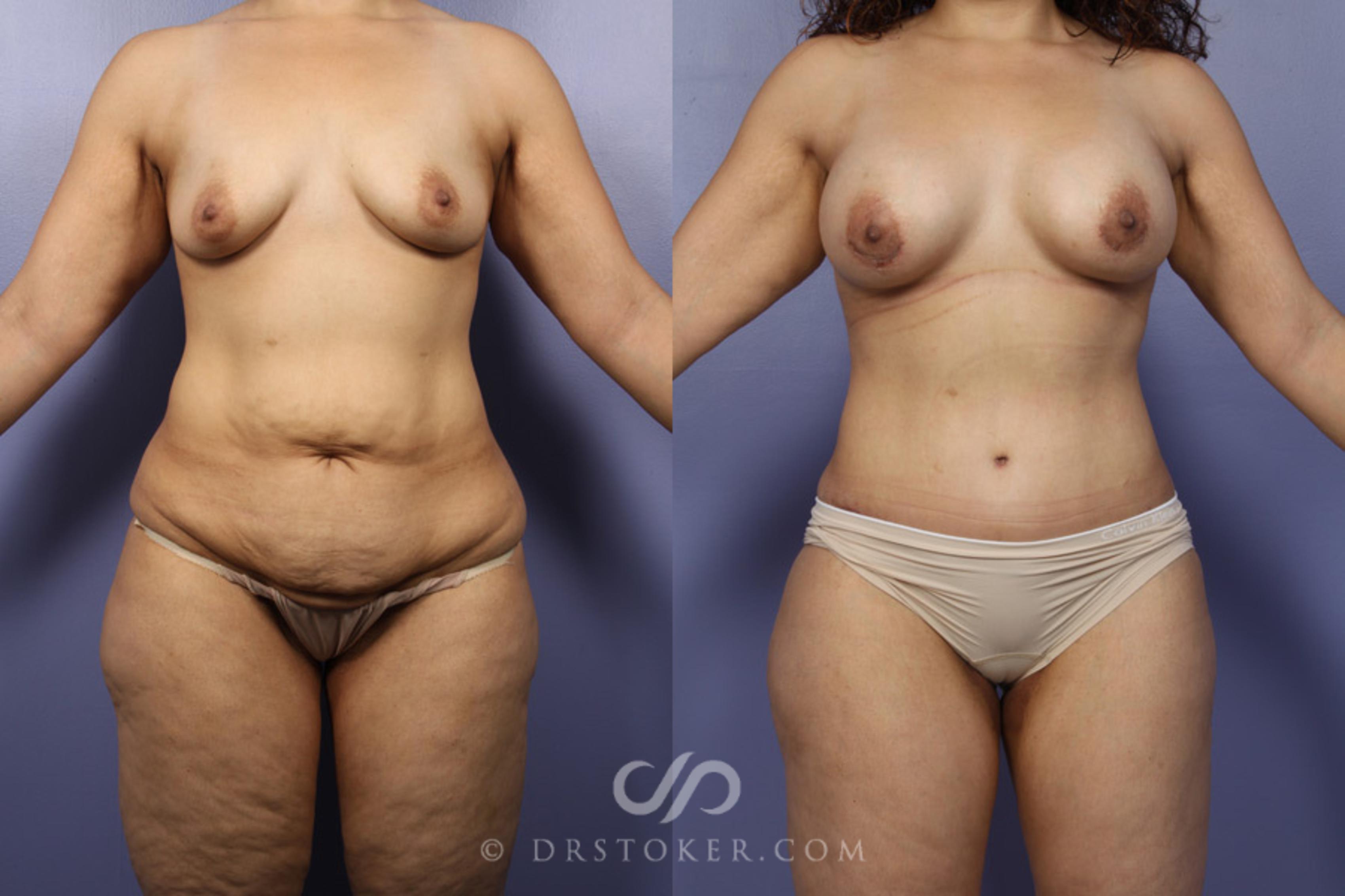 Before & After Tummy Tuck Case 346 View #1 View in Los Angeles, CA
