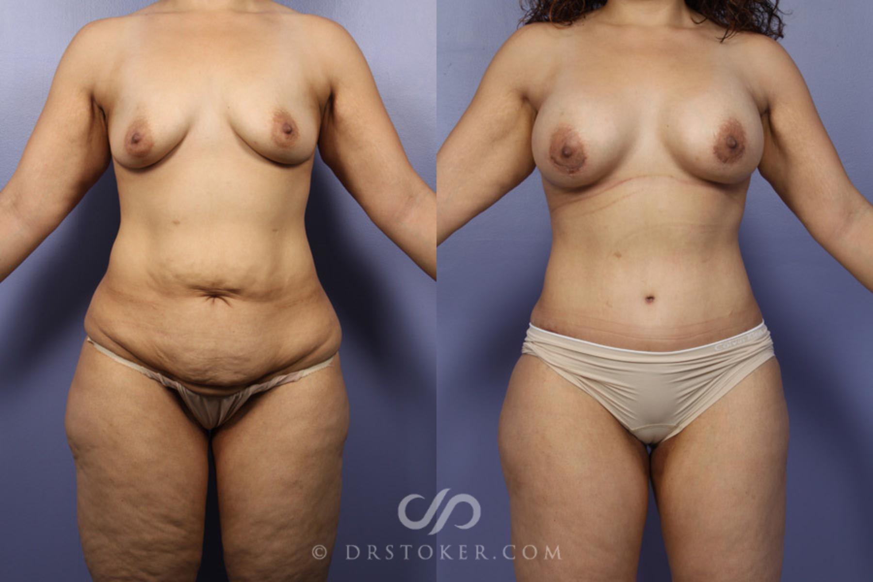 Before & After Liposuction Case 346 View #1 View in Los Angeles, CA