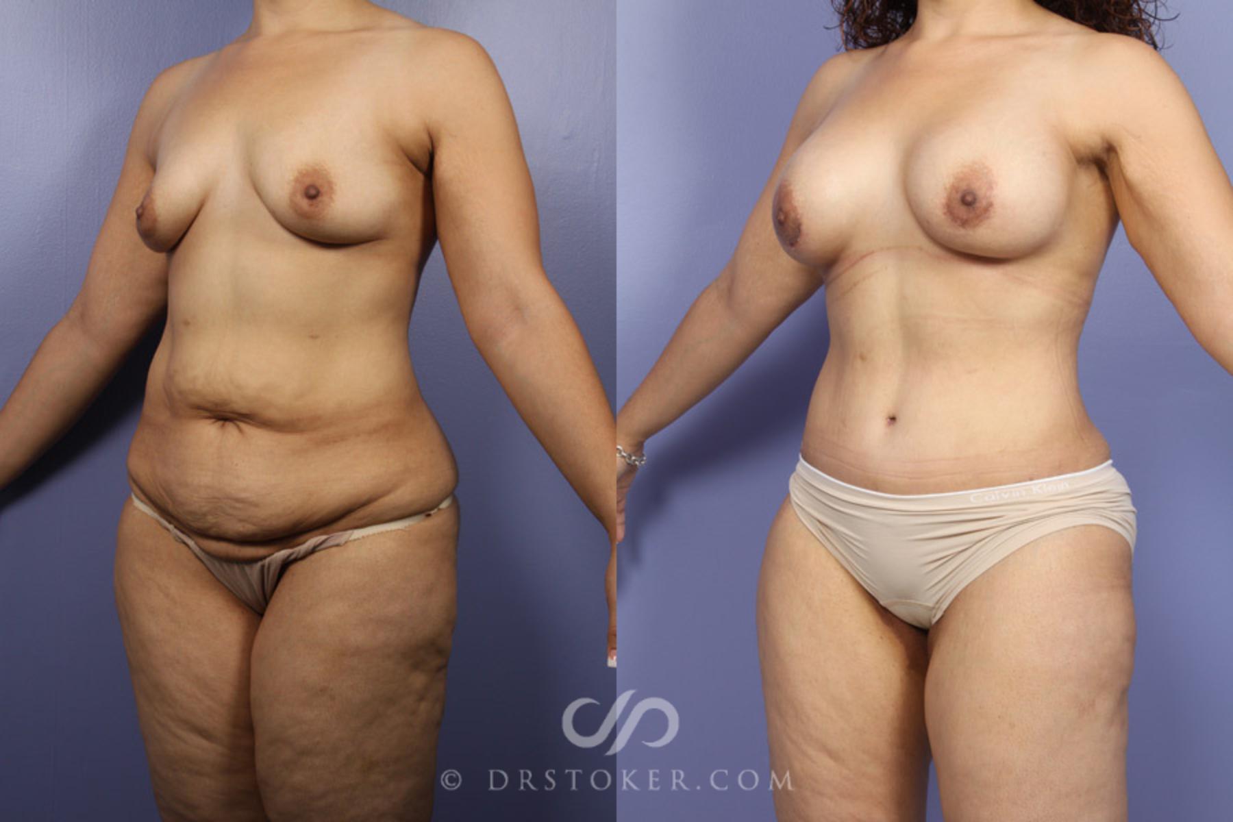 Before & After Liposuction Case 346 View #2 View in Los Angeles, CA