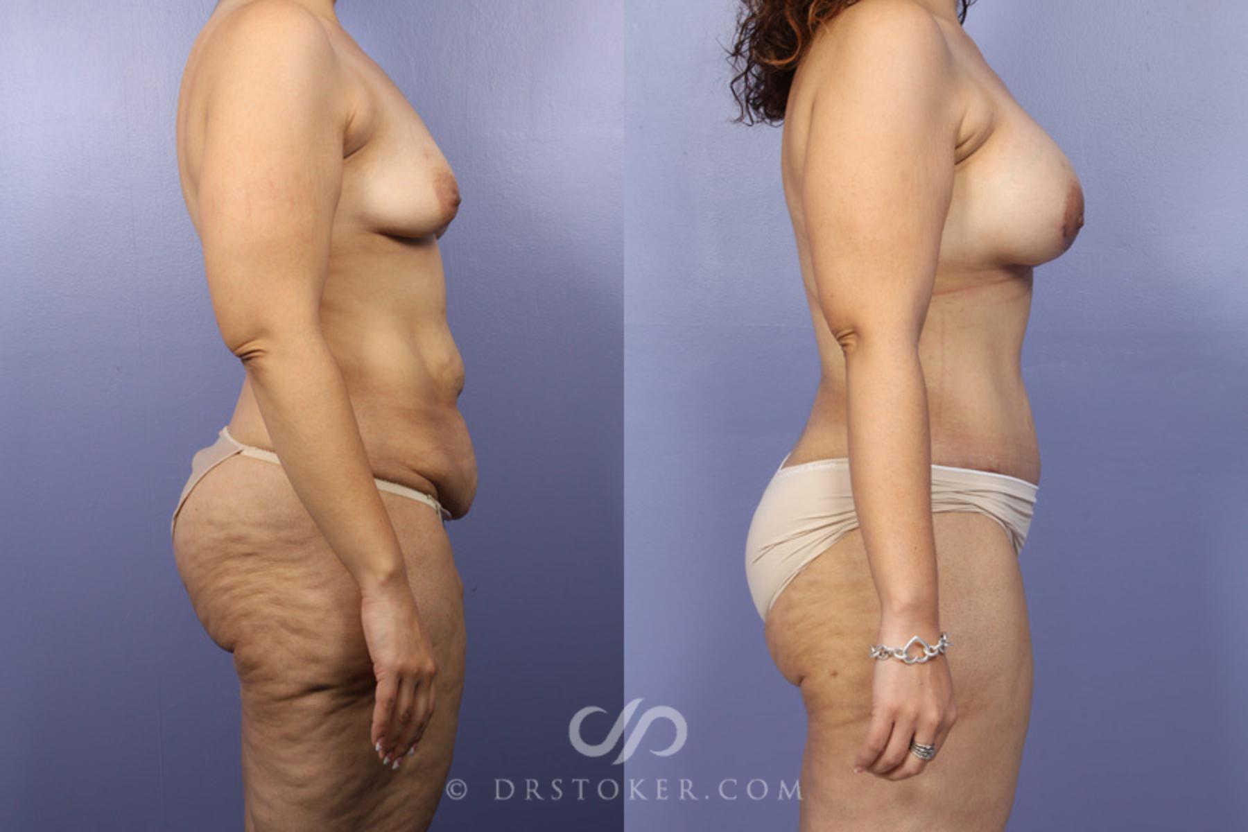 Before & After Liposuction Case 346 View #3 View in Los Angeles, CA