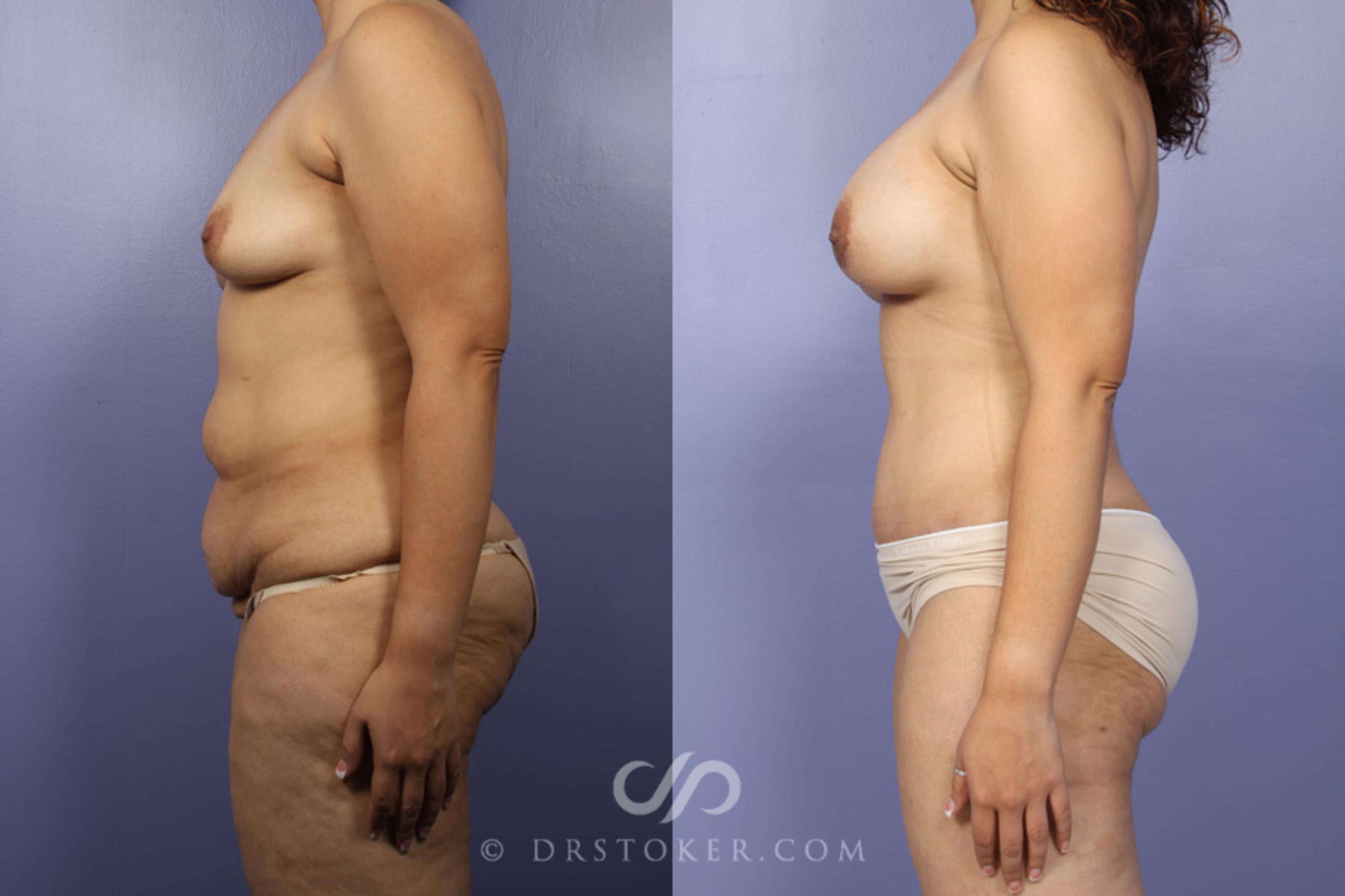 Before & After After Weight Loss Case 346 View #4 View in Los Angeles, CA