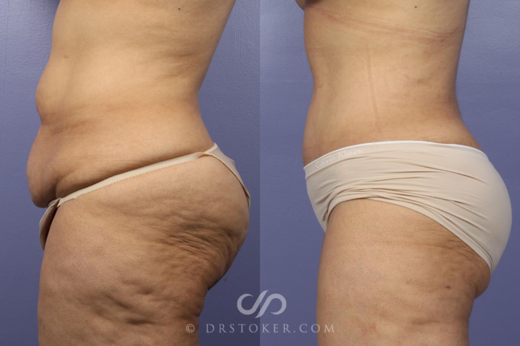 Before & After After Weight Loss Case 346 View #5 View in Los Angeles, CA