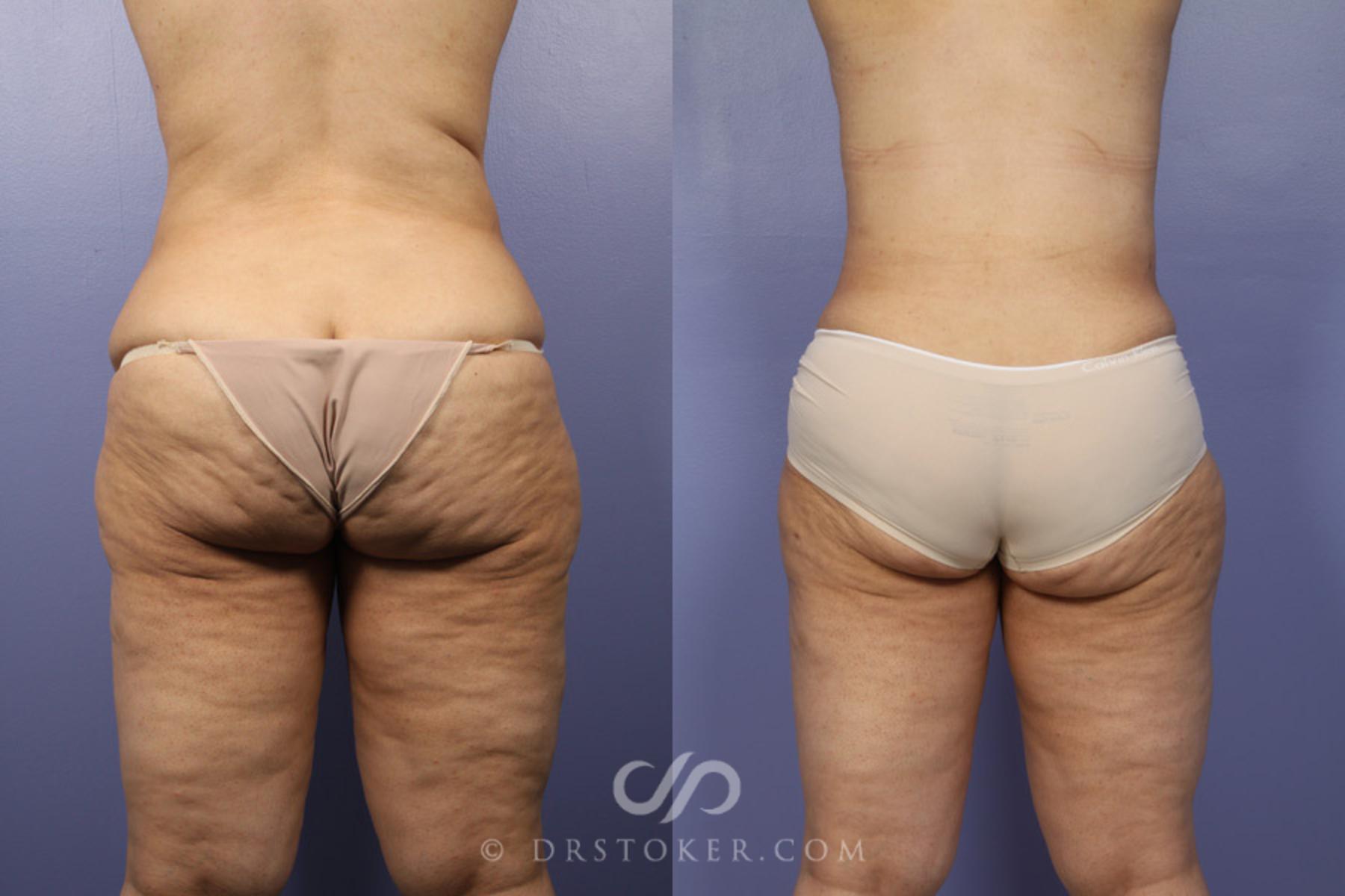 Before & After Liposuction Case 346 View #6 View in Los Angeles, CA