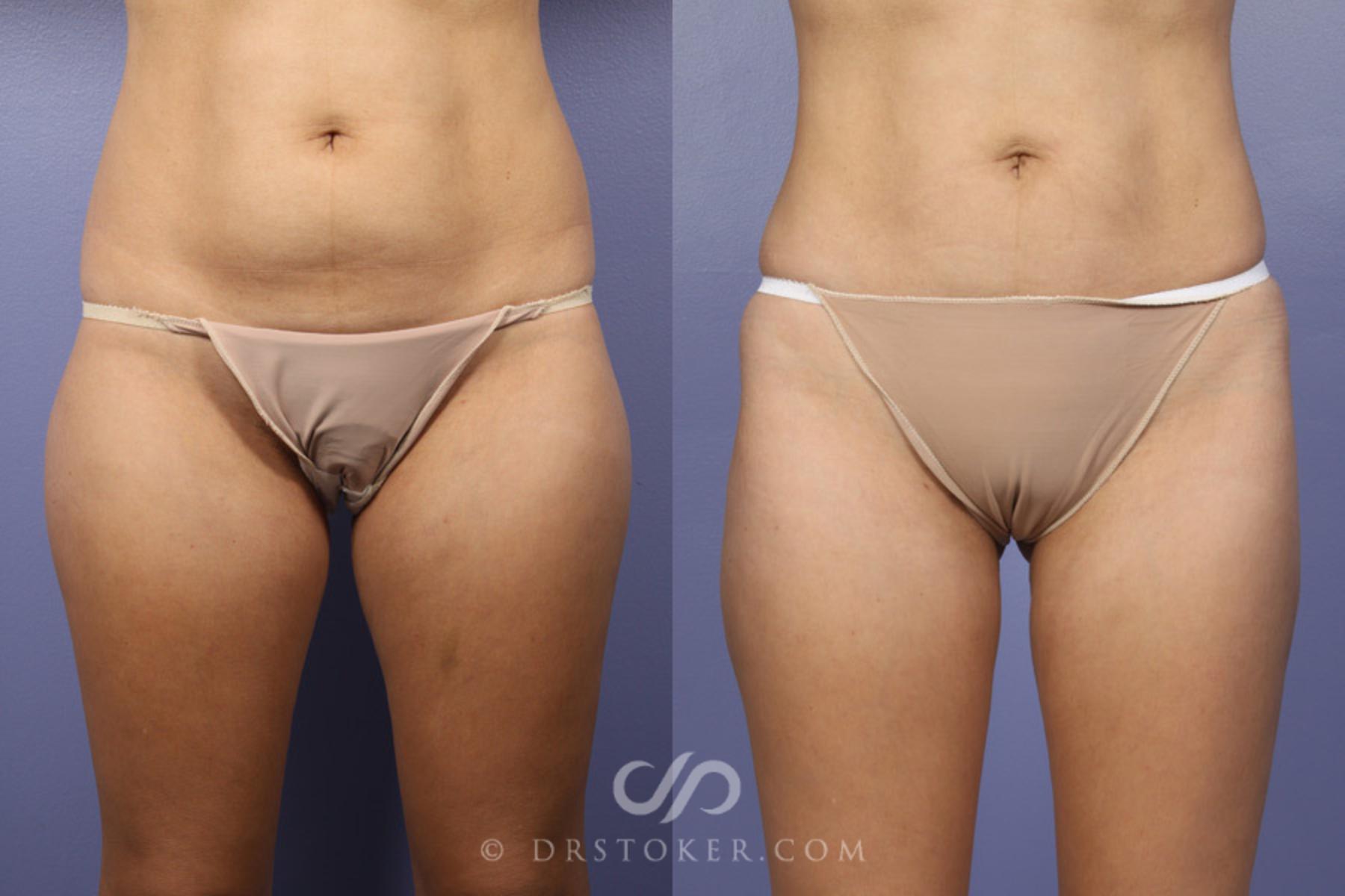 Before & After Liposuction Case 361 View #1 View in Los Angeles, CA
