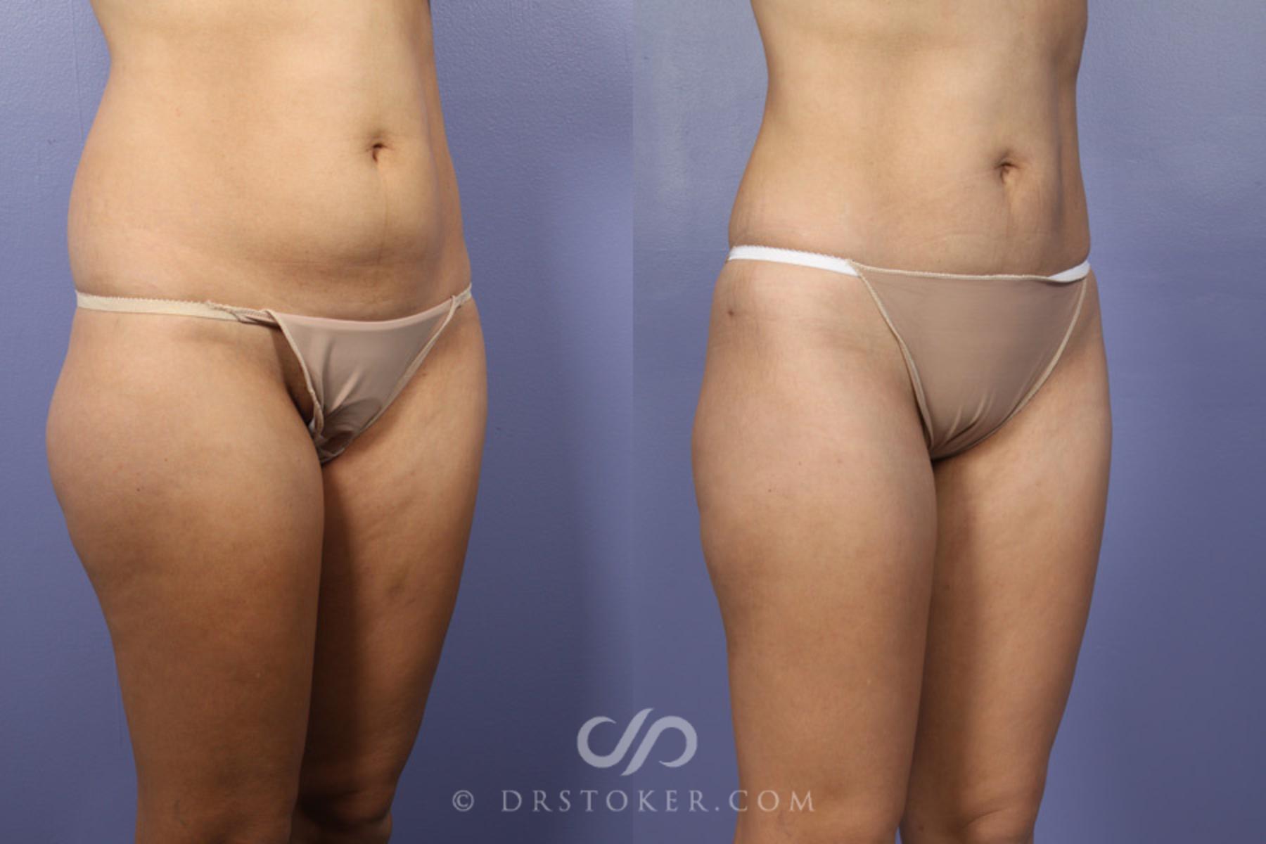 Before & After Liposuction Case 361 View #2 View in Los Angeles, CA