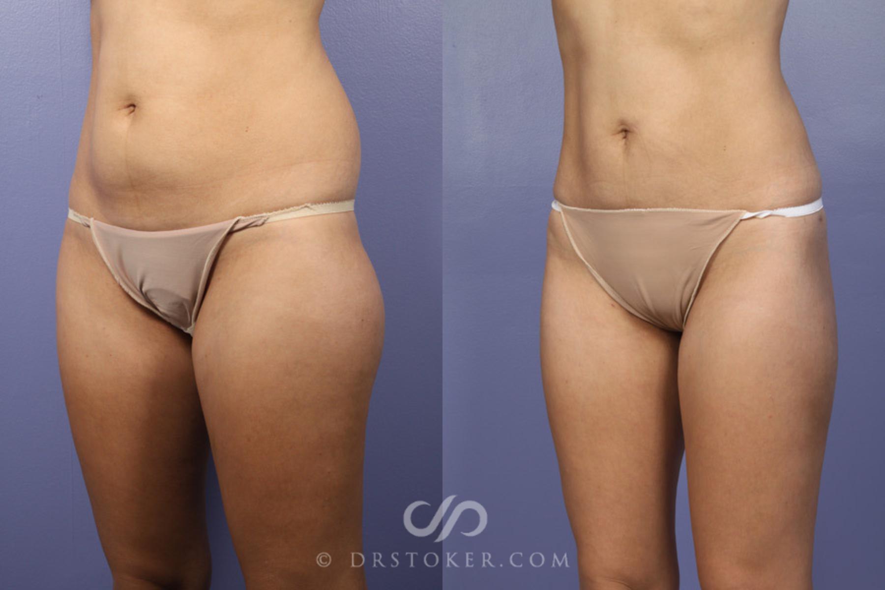 Before & After Liposuction Case 361 View #3 View in Los Angeles, CA