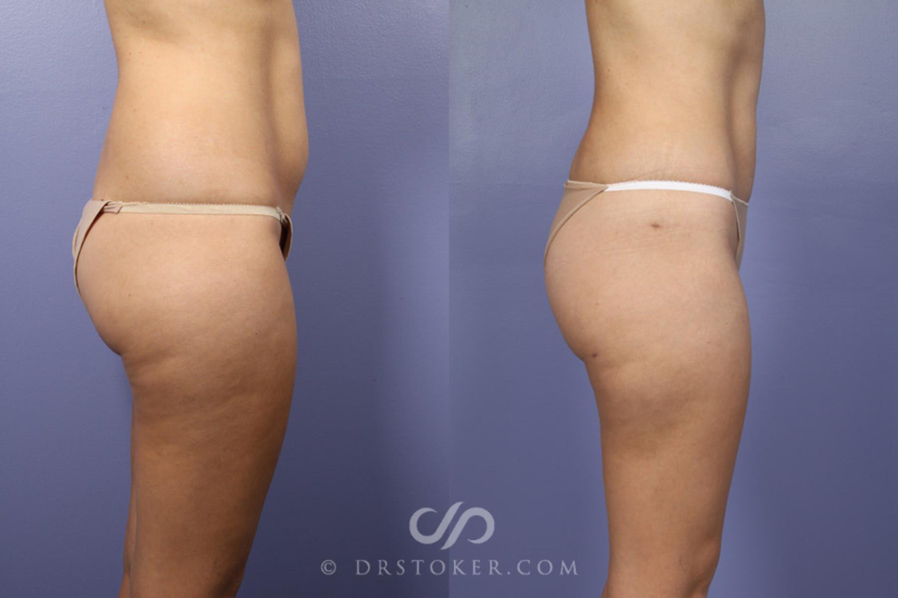 Before & After Liposuction Case 361 View #4 View in Los Angeles, CA