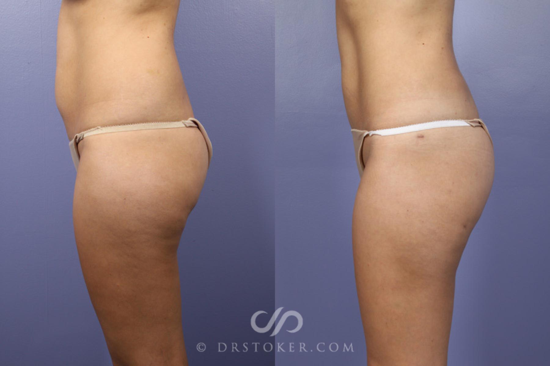 Before & After Liposuction Case 361 View #5 View in Los Angeles, CA