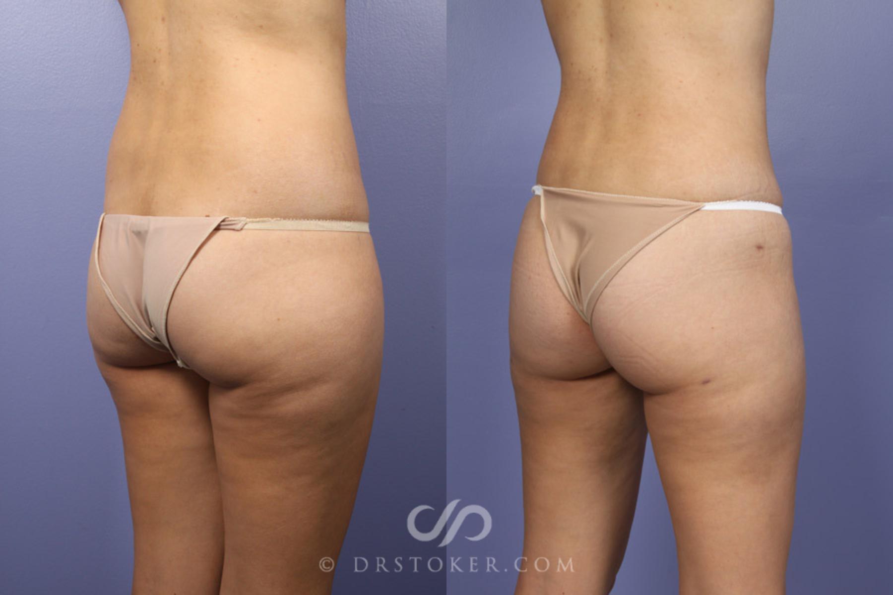 Before & After Liposuction Case 361 View #6 View in Los Angeles, CA