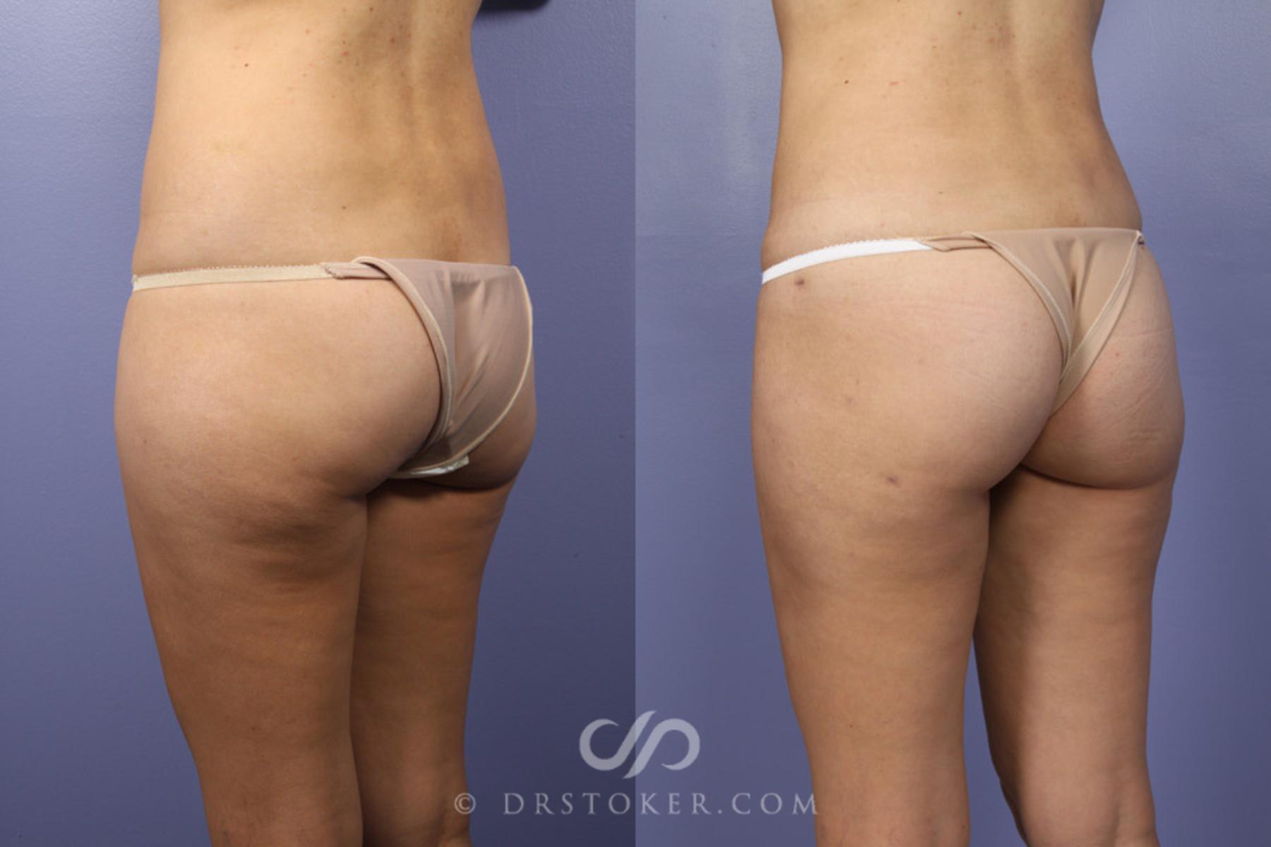 Before & After Liposuction Case 361 View #7 View in Los Angeles, CA