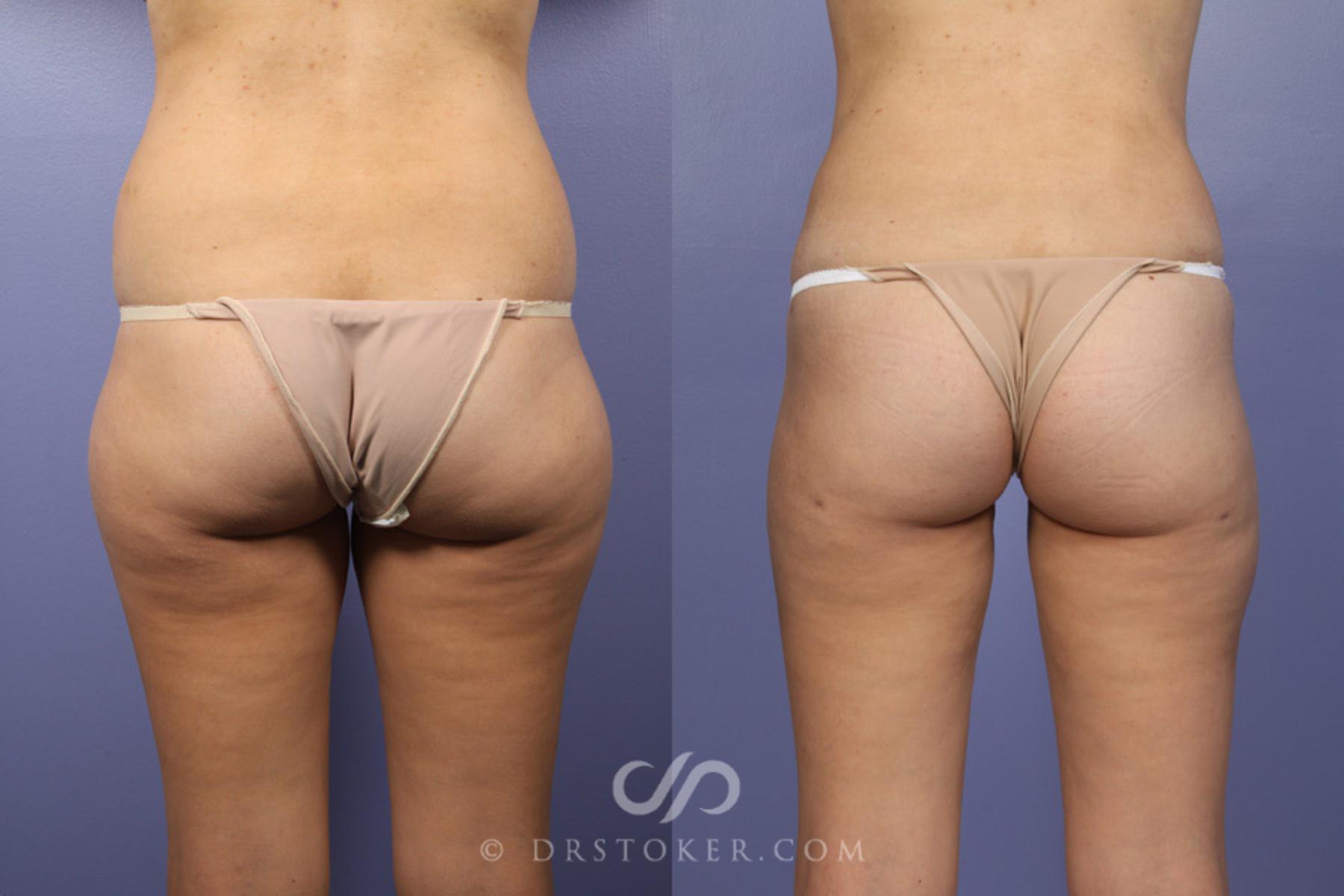 Before & After Liposuction Case 361 View #8 View in Los Angeles, CA