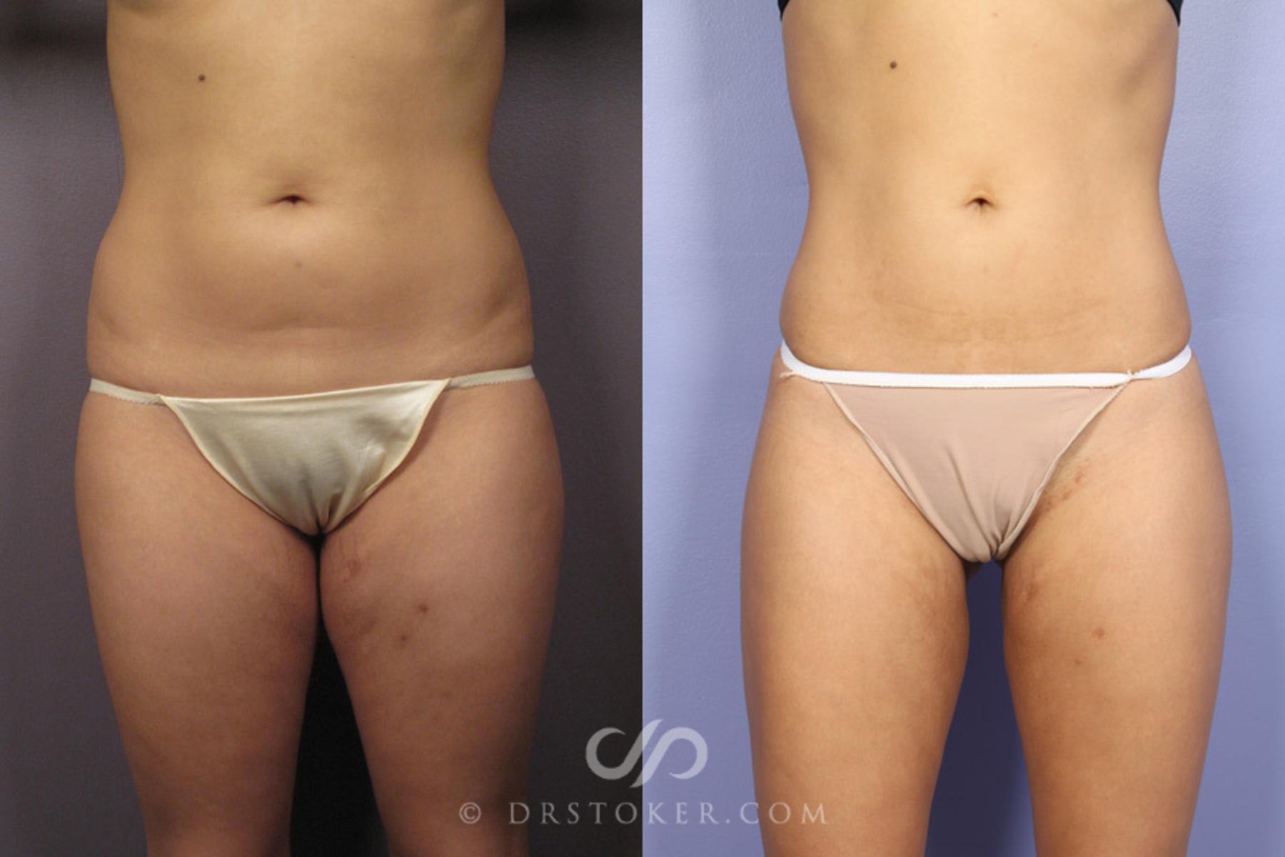 Before & After Liposuction Case 362 View #1 View in Los Angeles, CA