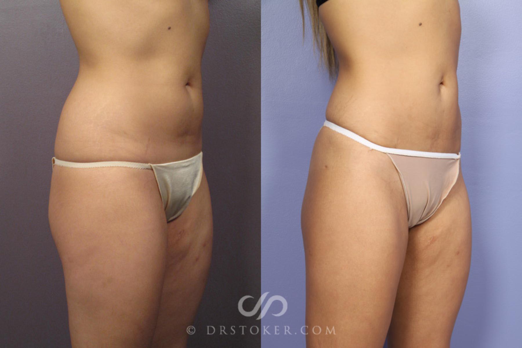 Before & After Liposuction Case 362 View #2 View in Los Angeles, CA
