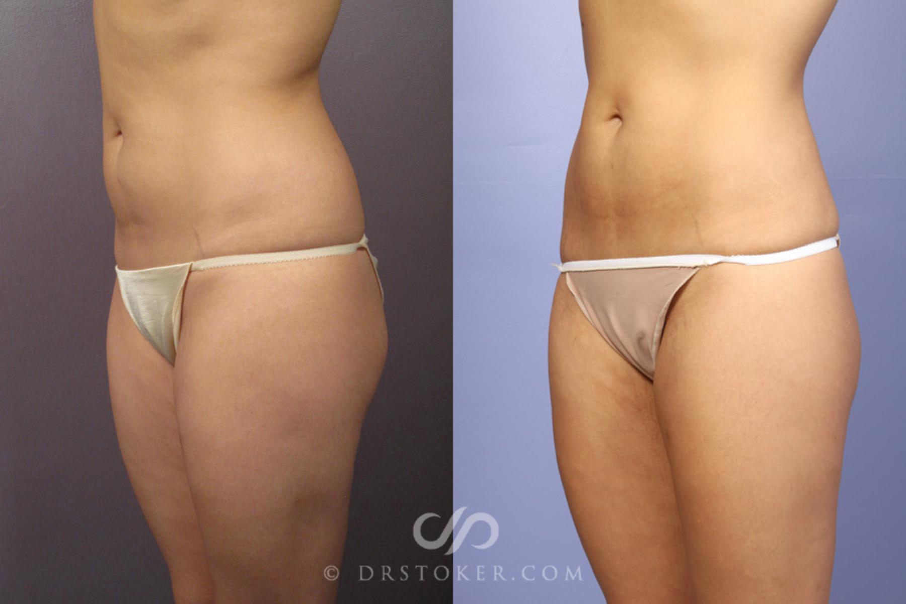 Before & After Liposuction Case 362 View #3 View in Los Angeles, CA