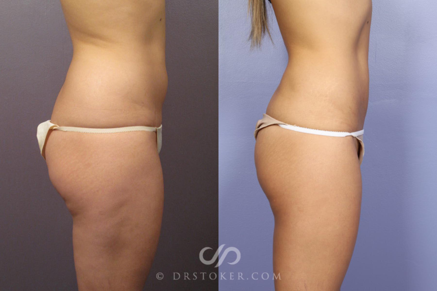 Before & After Liposuction Case 362 View #4 View in Los Angeles, CA