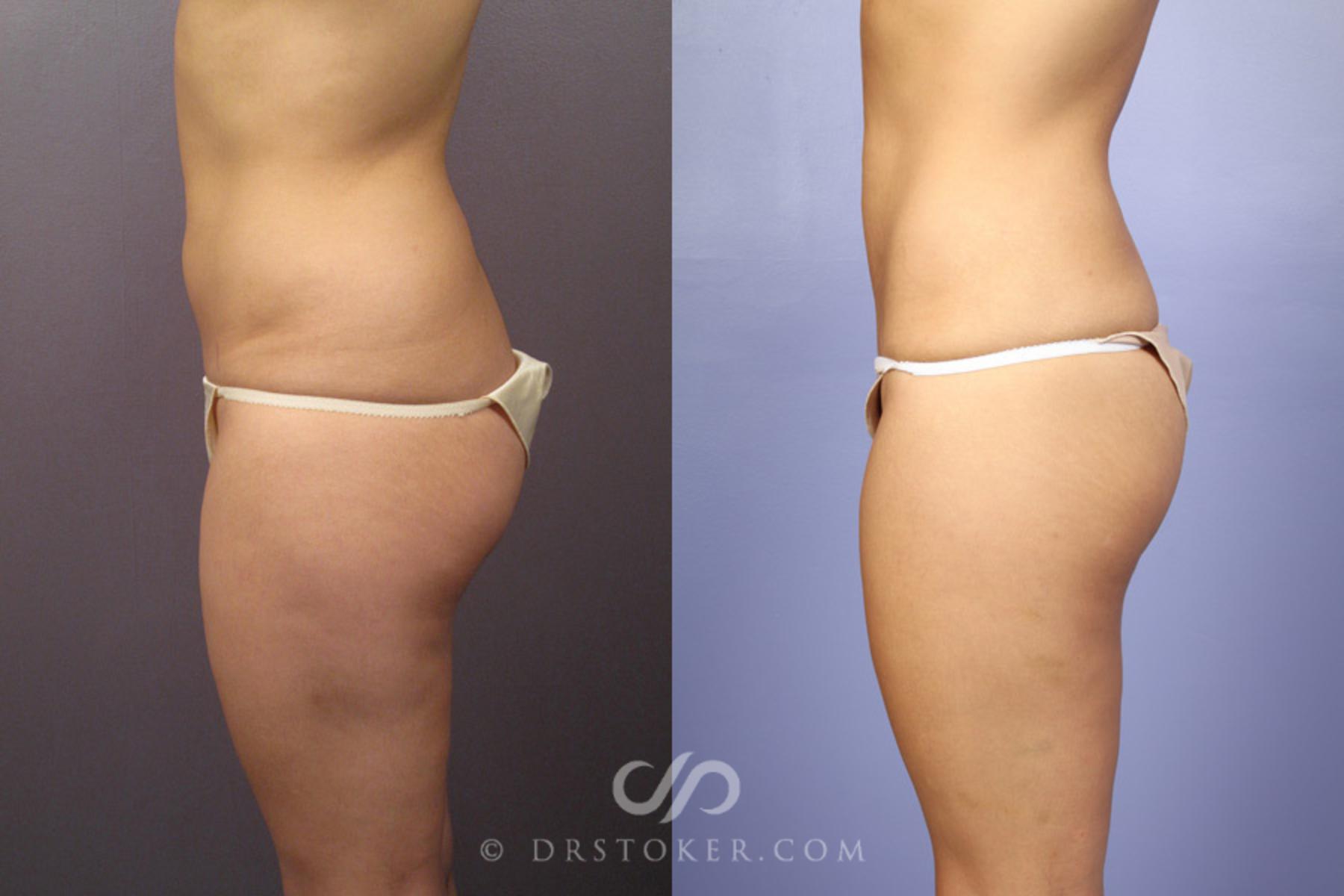 Abdomen Liposuction Beverly Hills - Los Angeles - Flatter Tummy