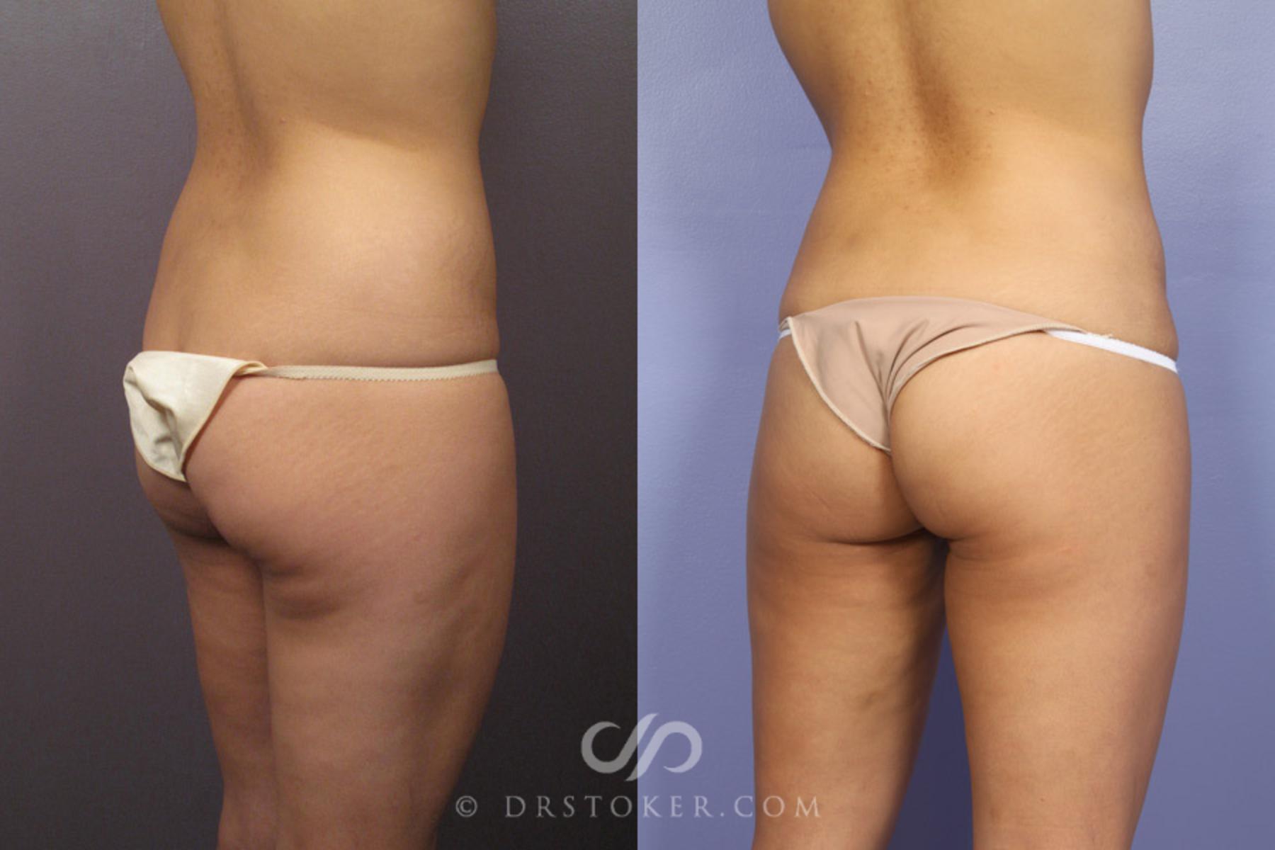 Before & After Liposuction Case 362 View #6 View in Los Angeles, CA