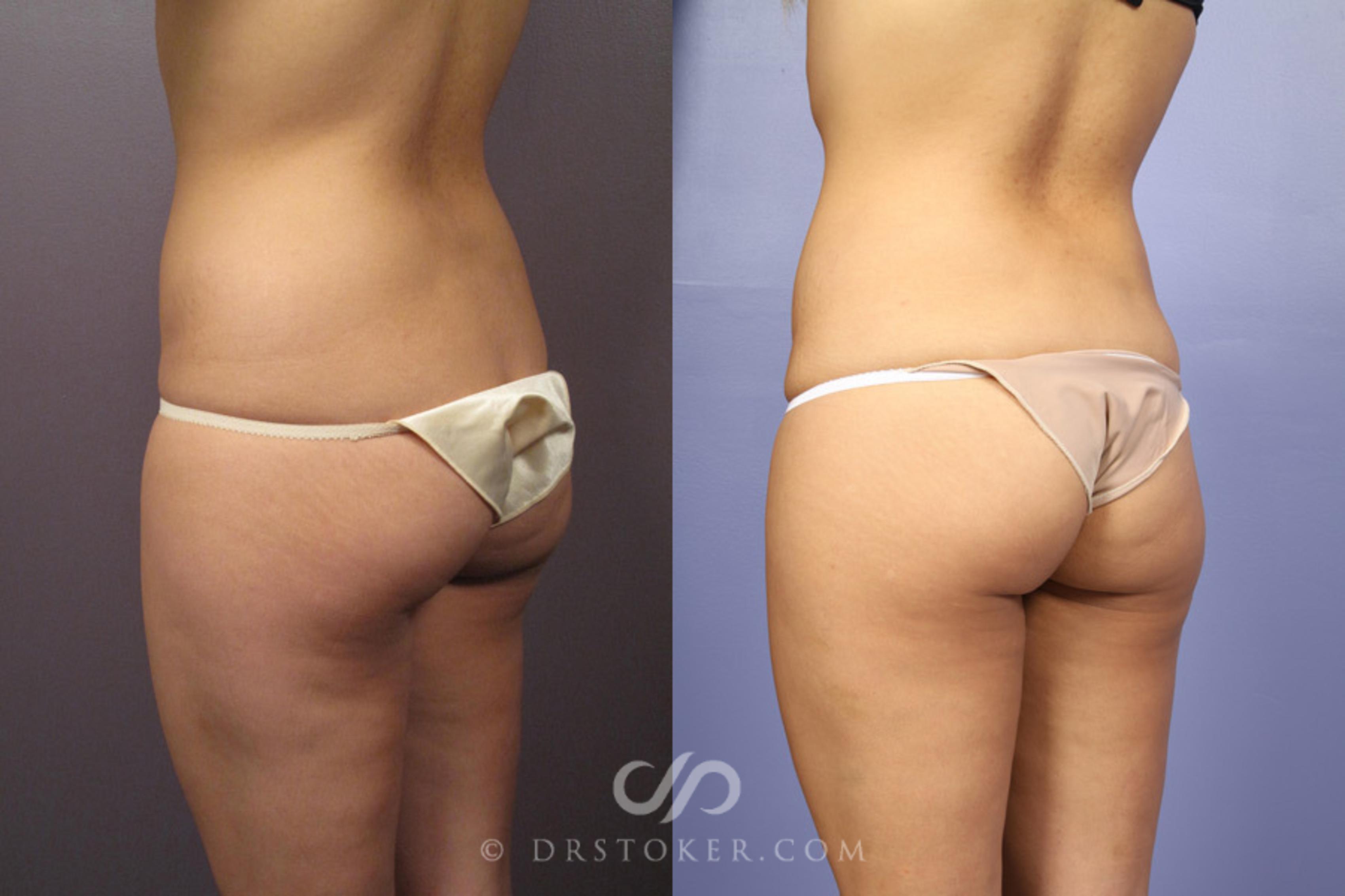 Before & After Liposuction Case 362 View #7 View in Los Angeles, CA