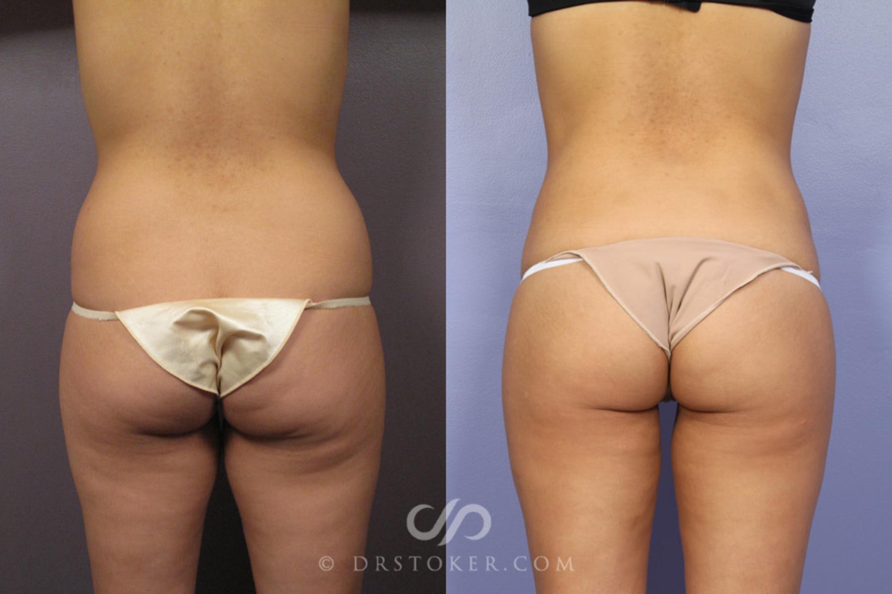 Before & After Liposuction Case 362 View #8 View in Los Angeles, CA