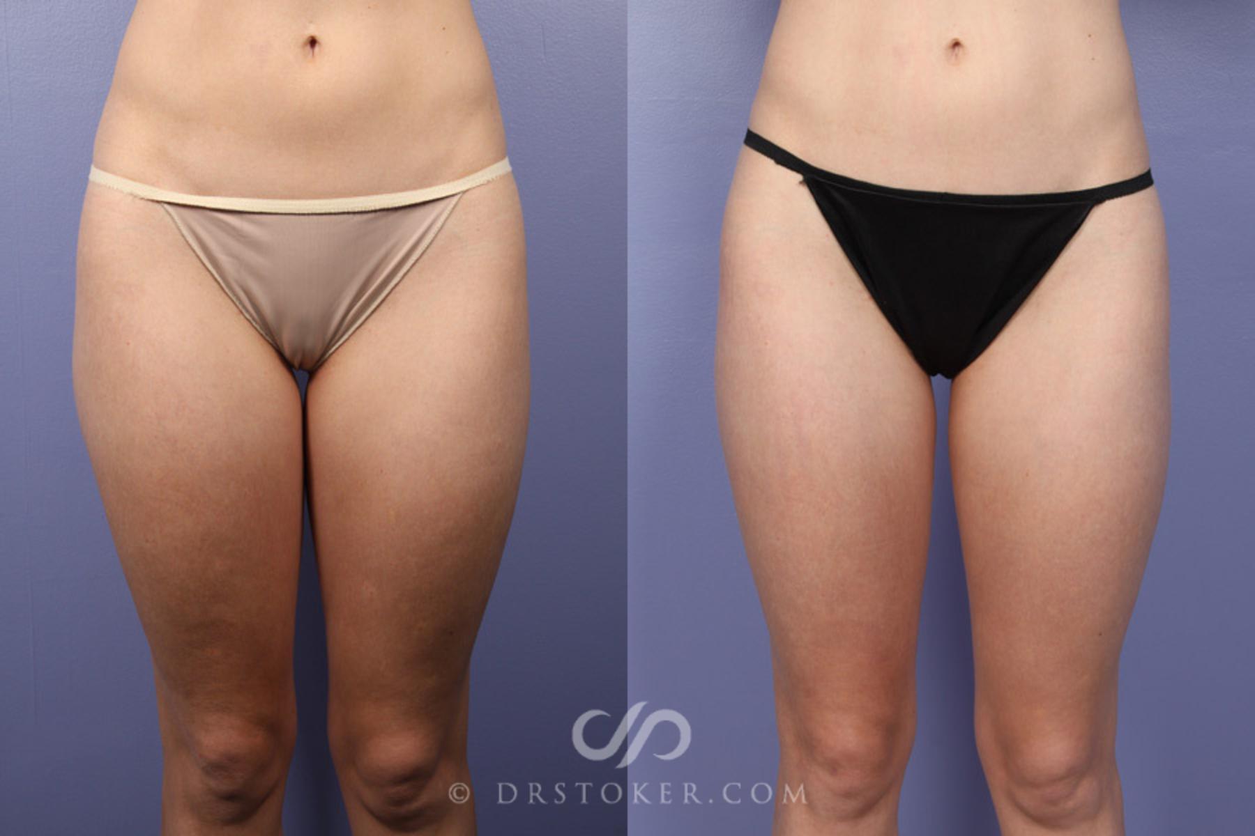 Before & After Liposuction Case 371 View #1 View in Los Angeles, CA