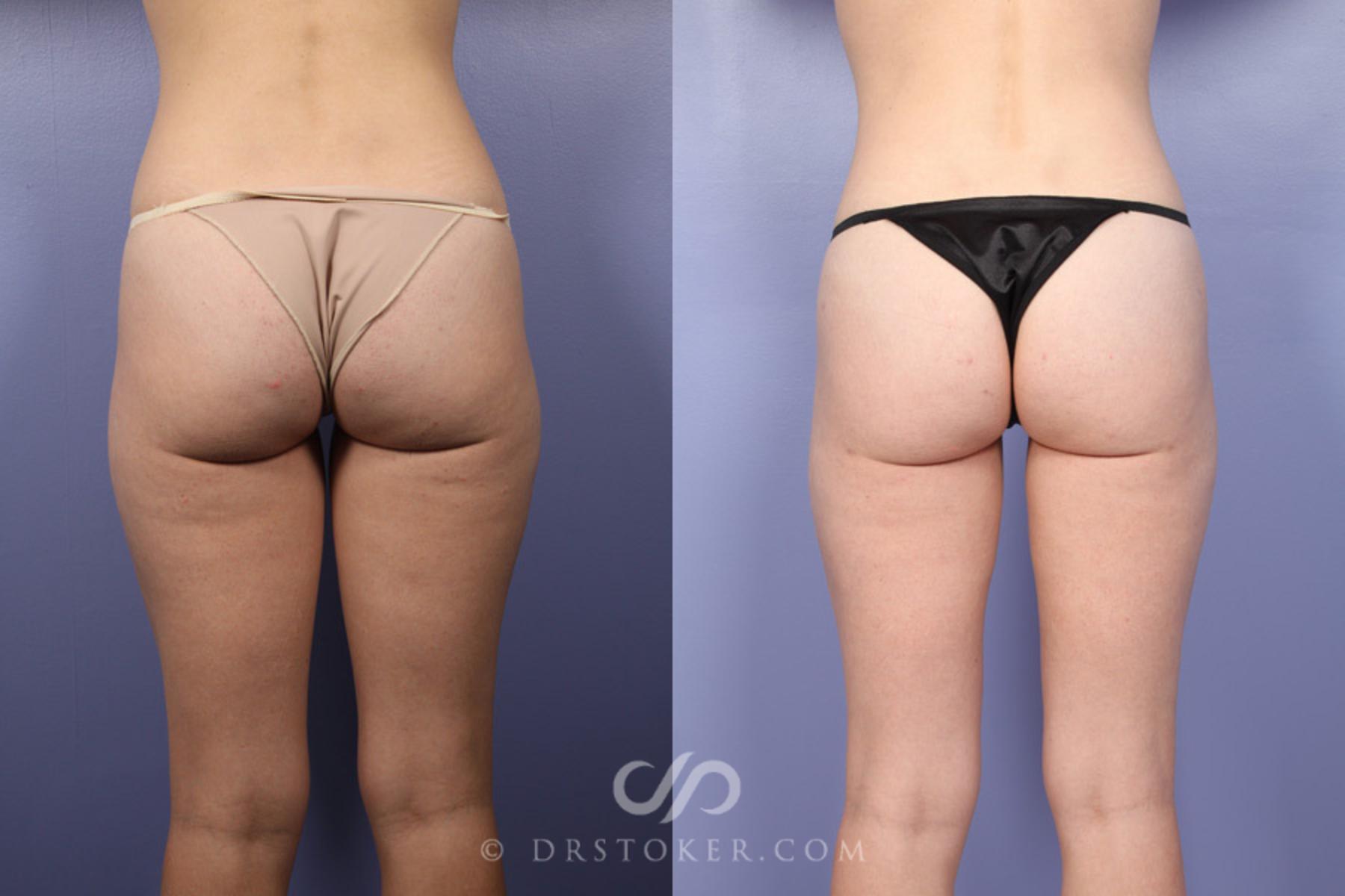 Before & After Liposuction Case 371 View #2 View in Los Angeles, CA