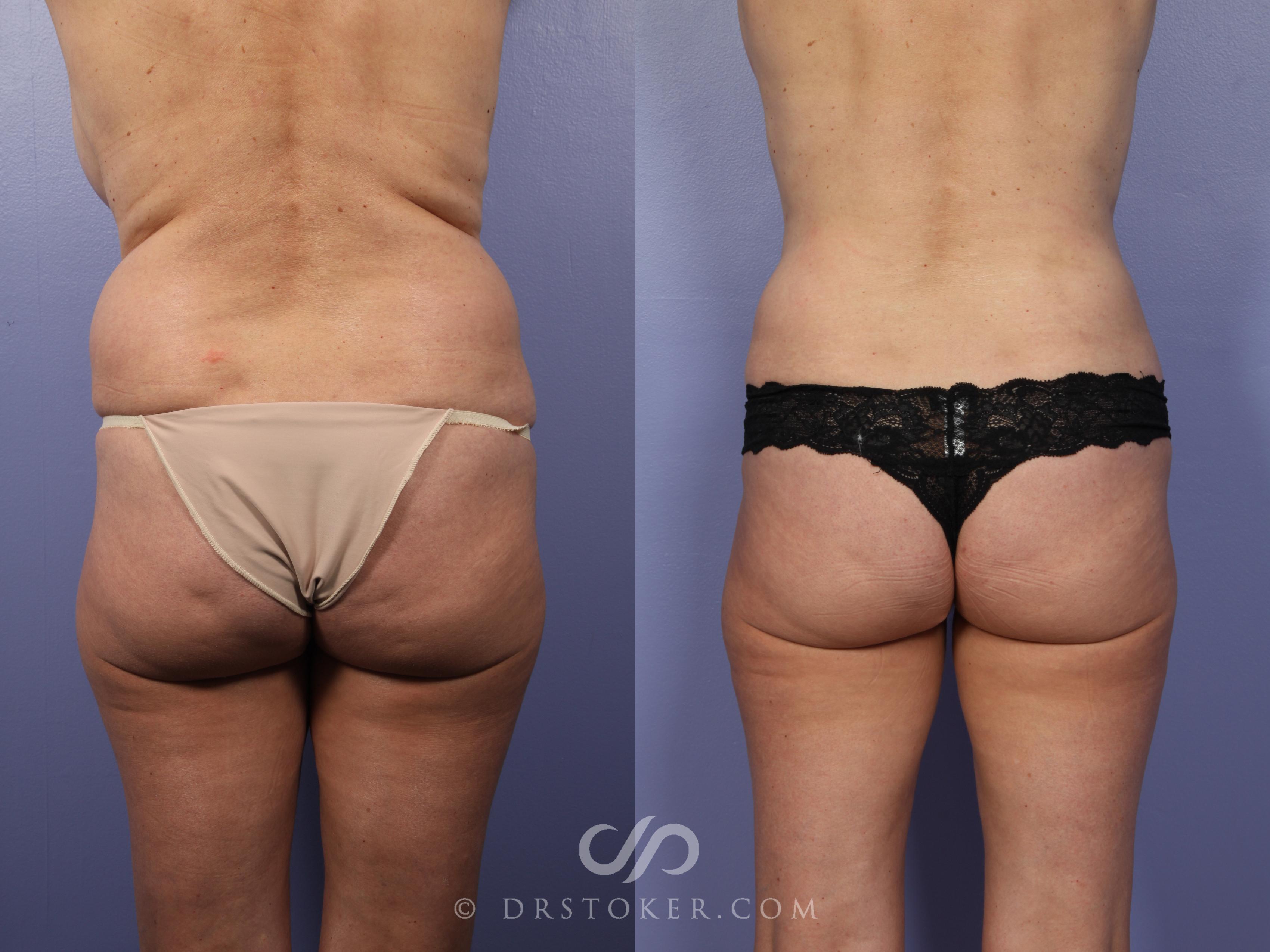 Before & After Liposuction Case 390 View #1 View in Los Angeles, CA