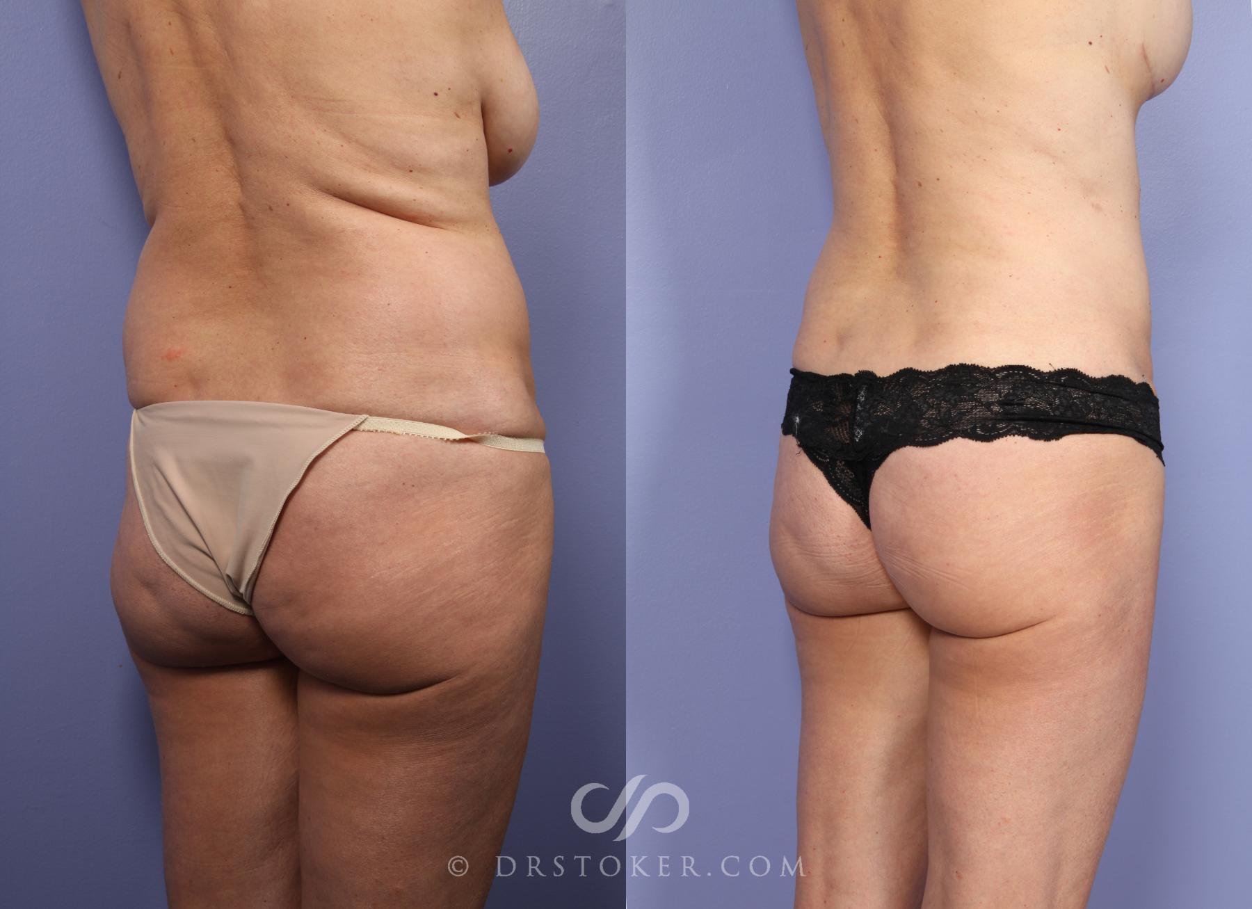 Before & After Liposuction Case 390 View #2 View in Los Angeles, CA