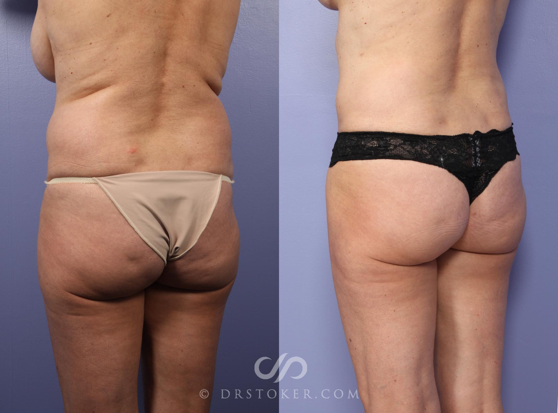 Before & After Liposuction Case 390 View #3 View in Los Angeles, CA