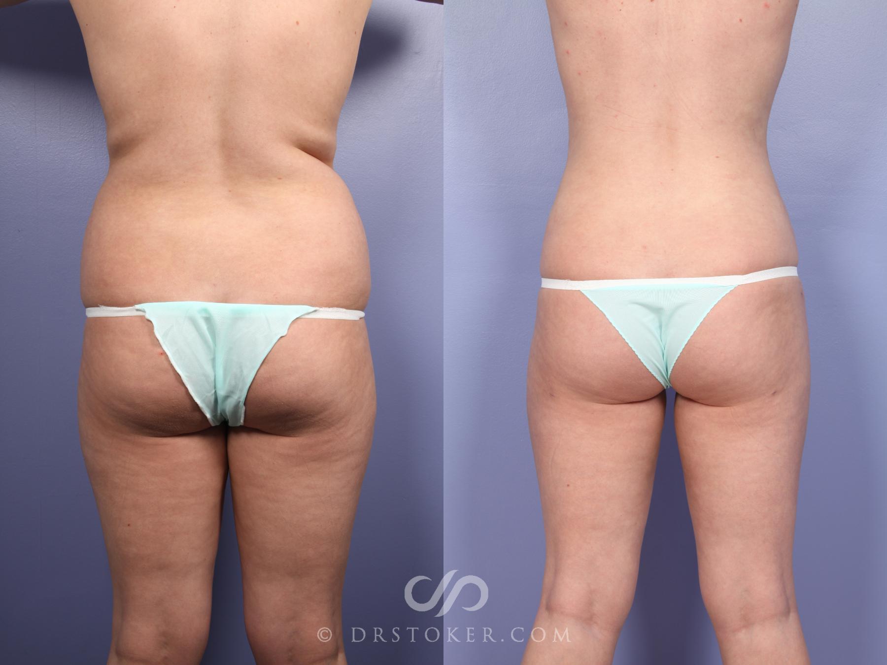 Before & After Liposuction Case 391 View #1 View in Los Angeles, CA