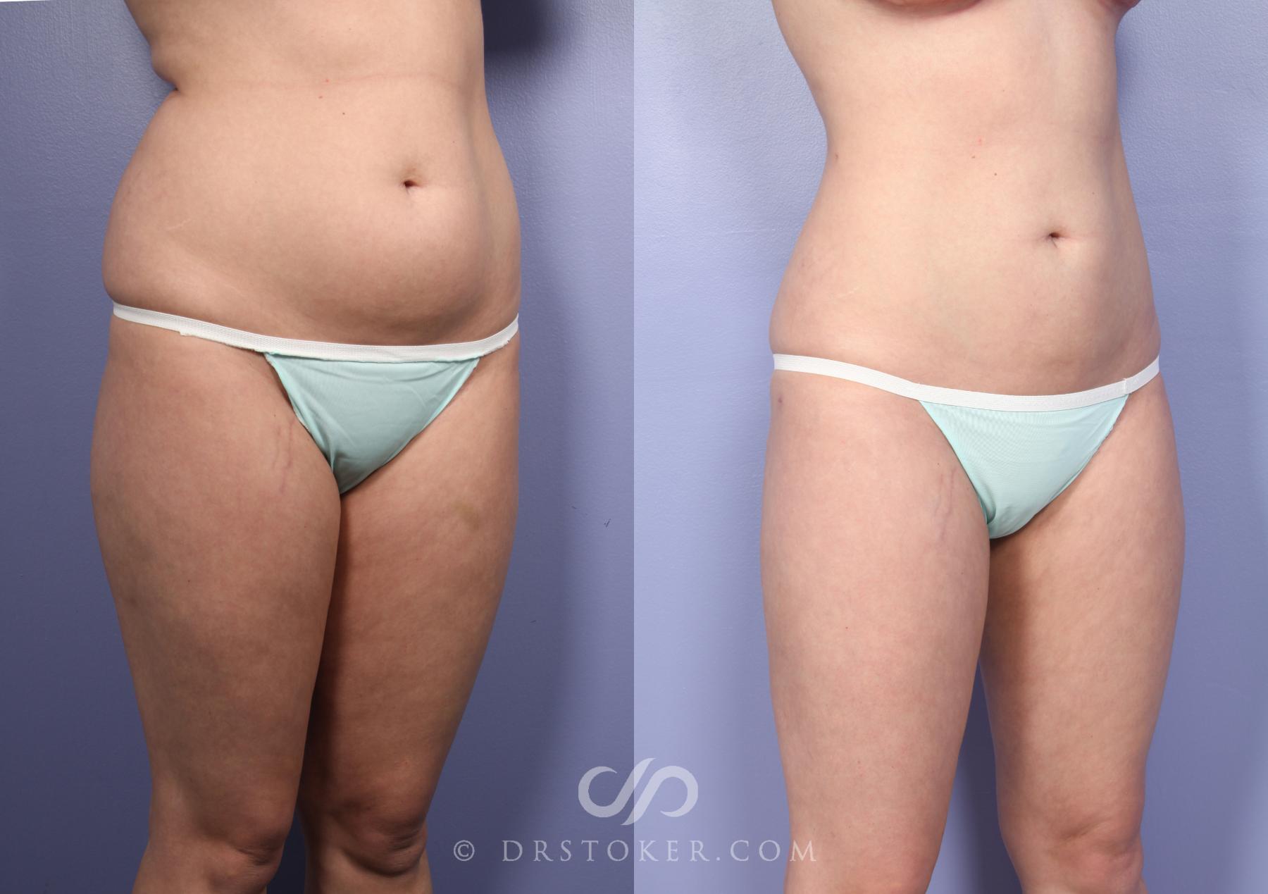 Before & After Liposuction Case 391 View #10 View in Los Angeles, CA