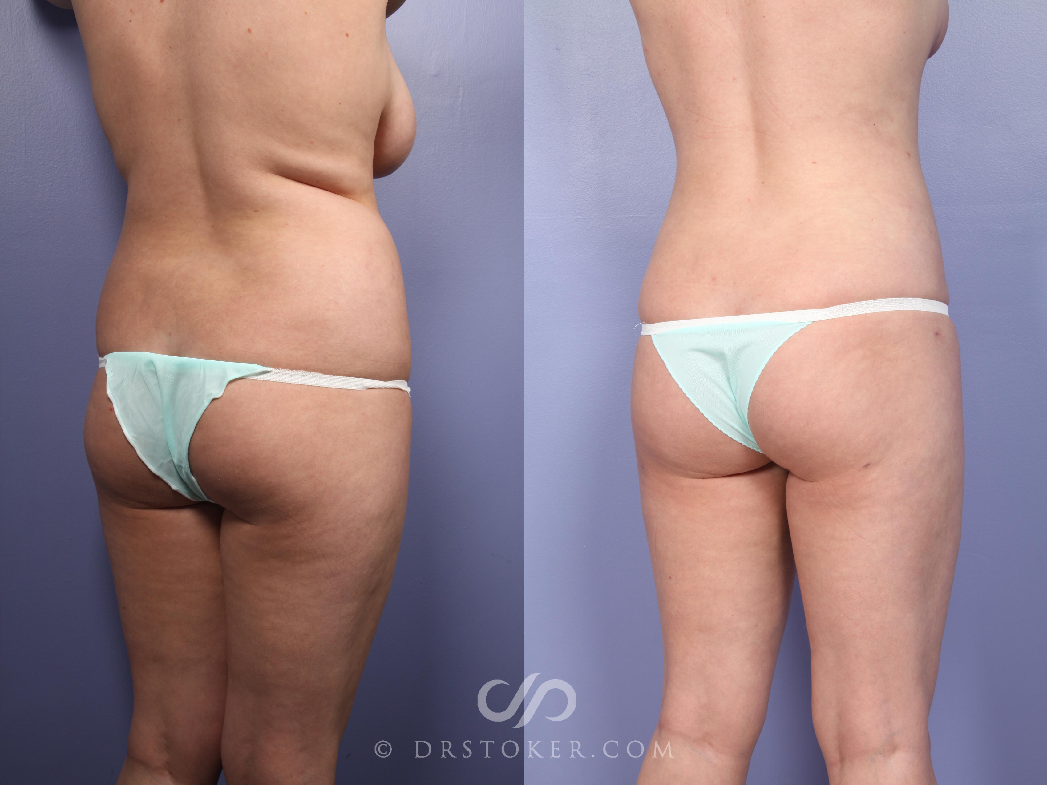 Before & After Liposuction Case 391 View #2 View in Los Angeles, CA