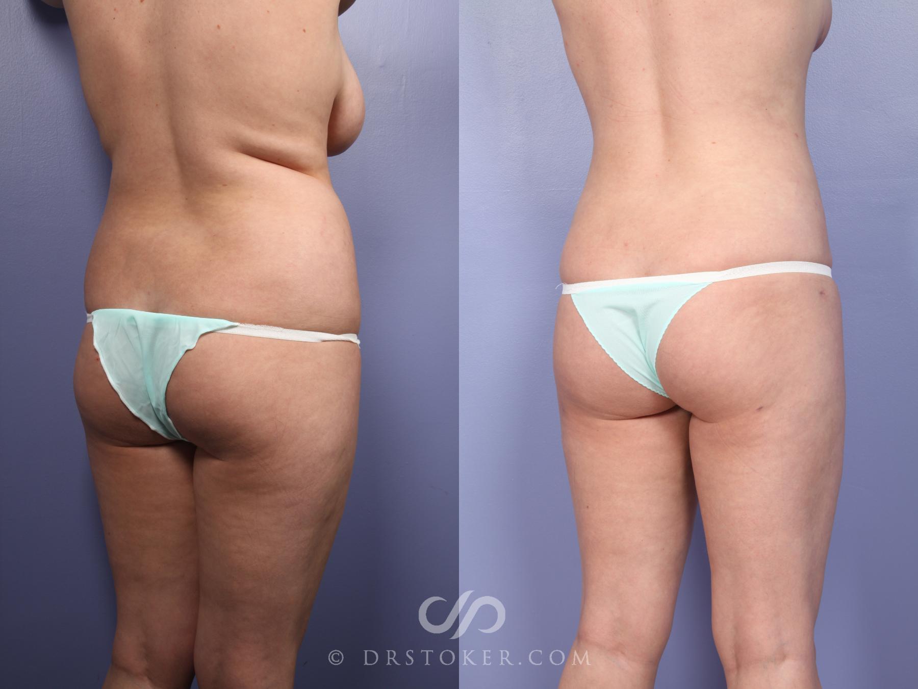 Before & After Liposuction Case 391 View #2 View in Los Angeles, CA