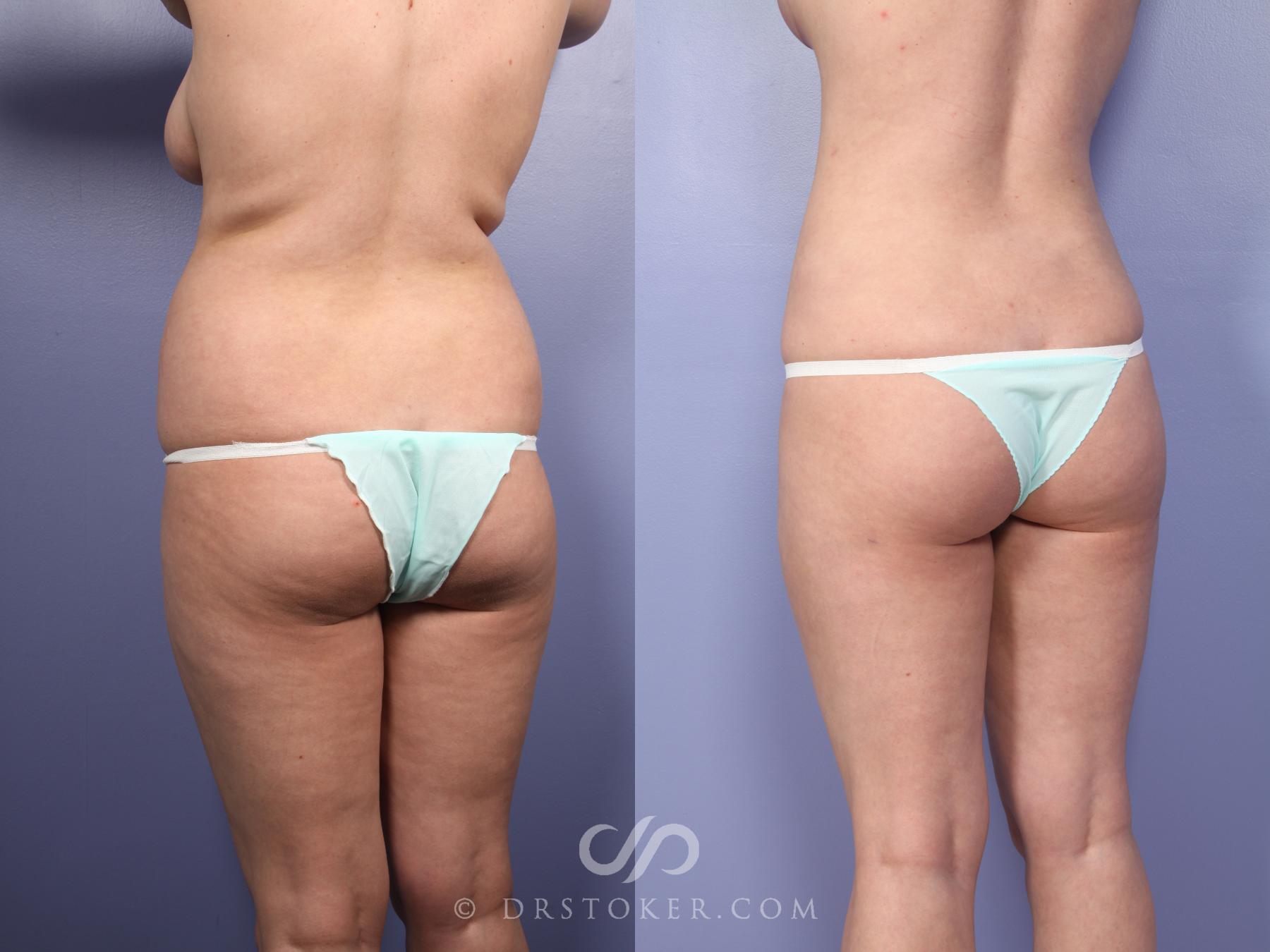 Before & After Liposuction Case 391 View #3 View in Los Angeles, CA