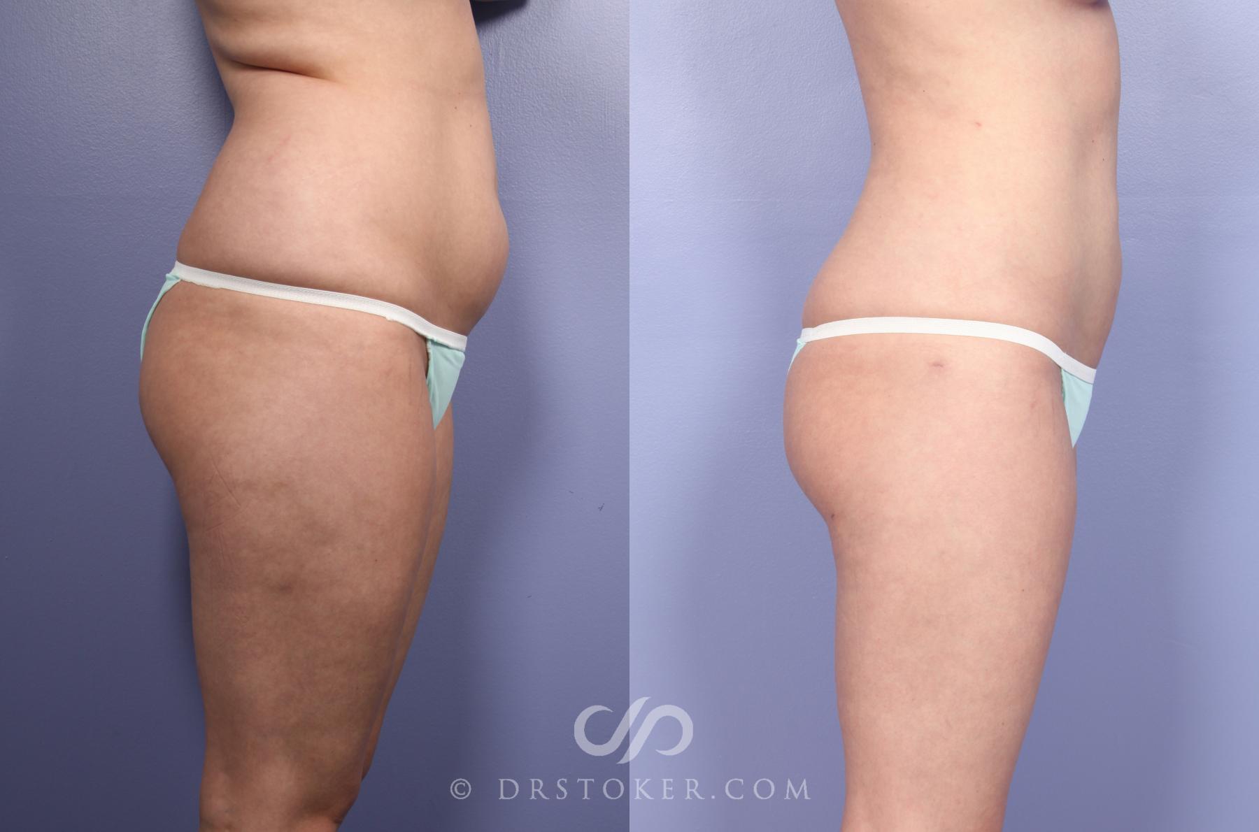 Before & After Liposuction Case 391 View #4 View in Los Angeles, CA