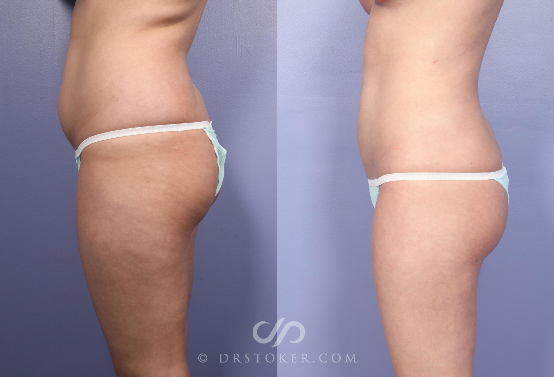 Before & After Liposuction Case 391 View #5 View in Los Angeles, CA