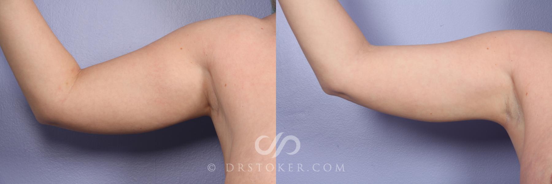 Before & After Liposuction Case 391 View #6 View in Los Angeles, CA