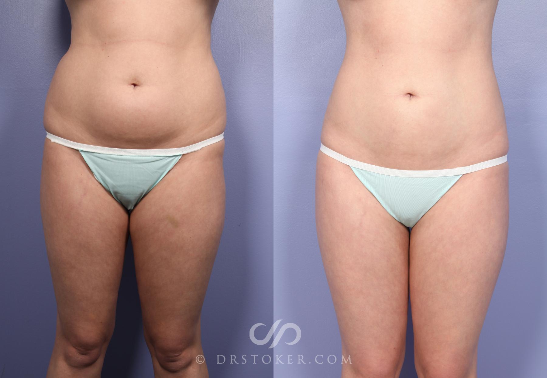 Before & After Liposuction Case 391 View #8 View in Los Angeles, CA
