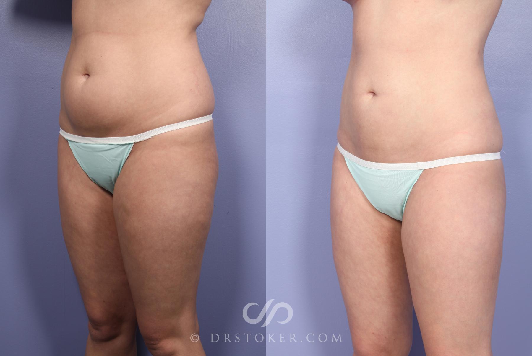 Before & After Liposuction Case 391 View #9 View in Los Angeles, CA