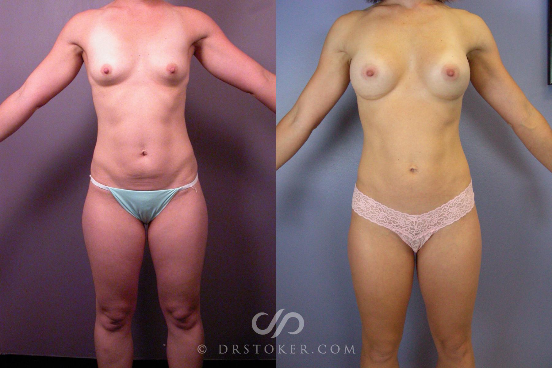 Before & After Liposuction Case 393 View #1 View in Los Angeles, CA
