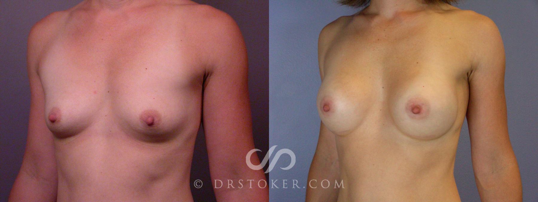 Before & After Liposuction Case 393 View #10 View in Los Angeles, CA