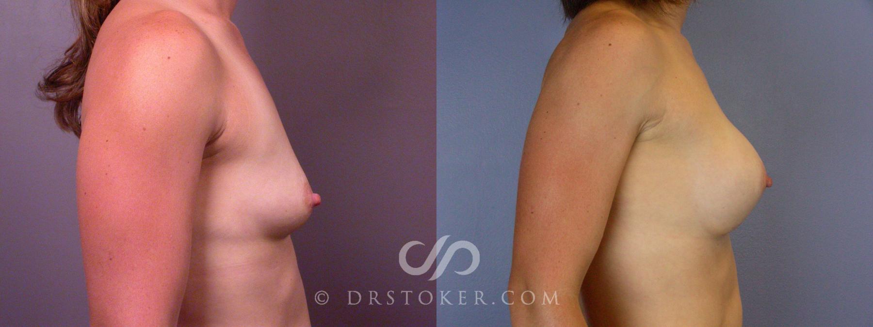 Before & After Liposuction Case 393 View #11 View in Los Angeles, CA