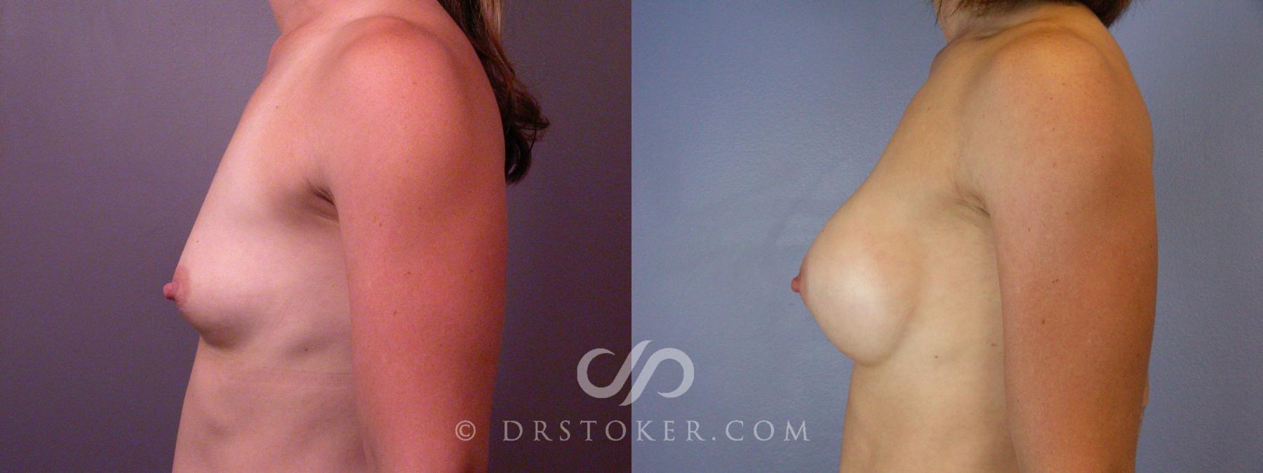 Before & After Liposuction Case 393 View #12 View in Los Angeles, CA