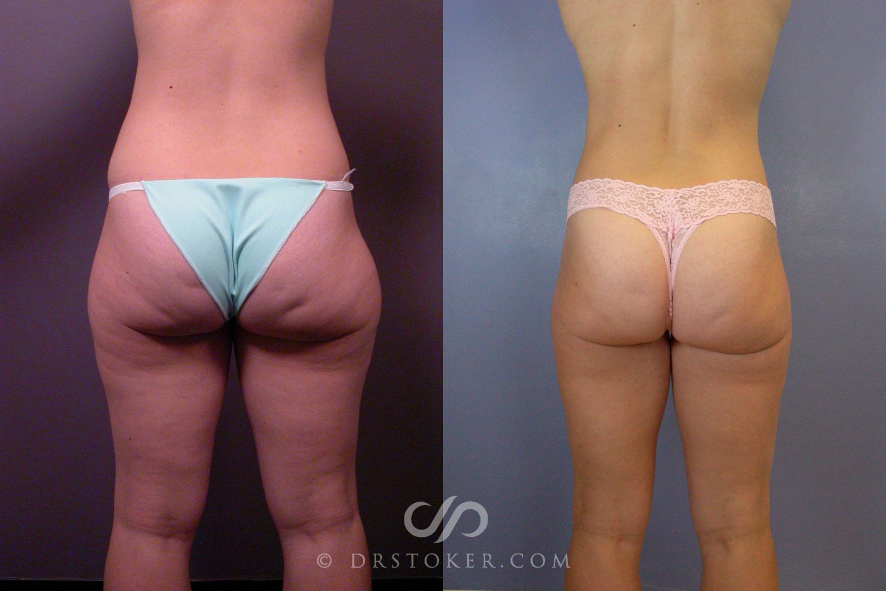 Before & After Liposuction Case 393 View #2 View in Los Angeles, CA