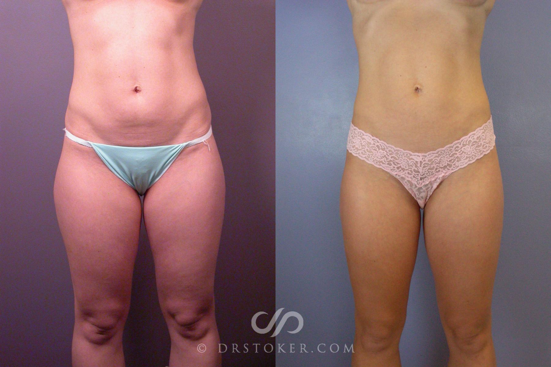 Before & After Liposuction Case 393 View #3 View in Los Angeles, CA